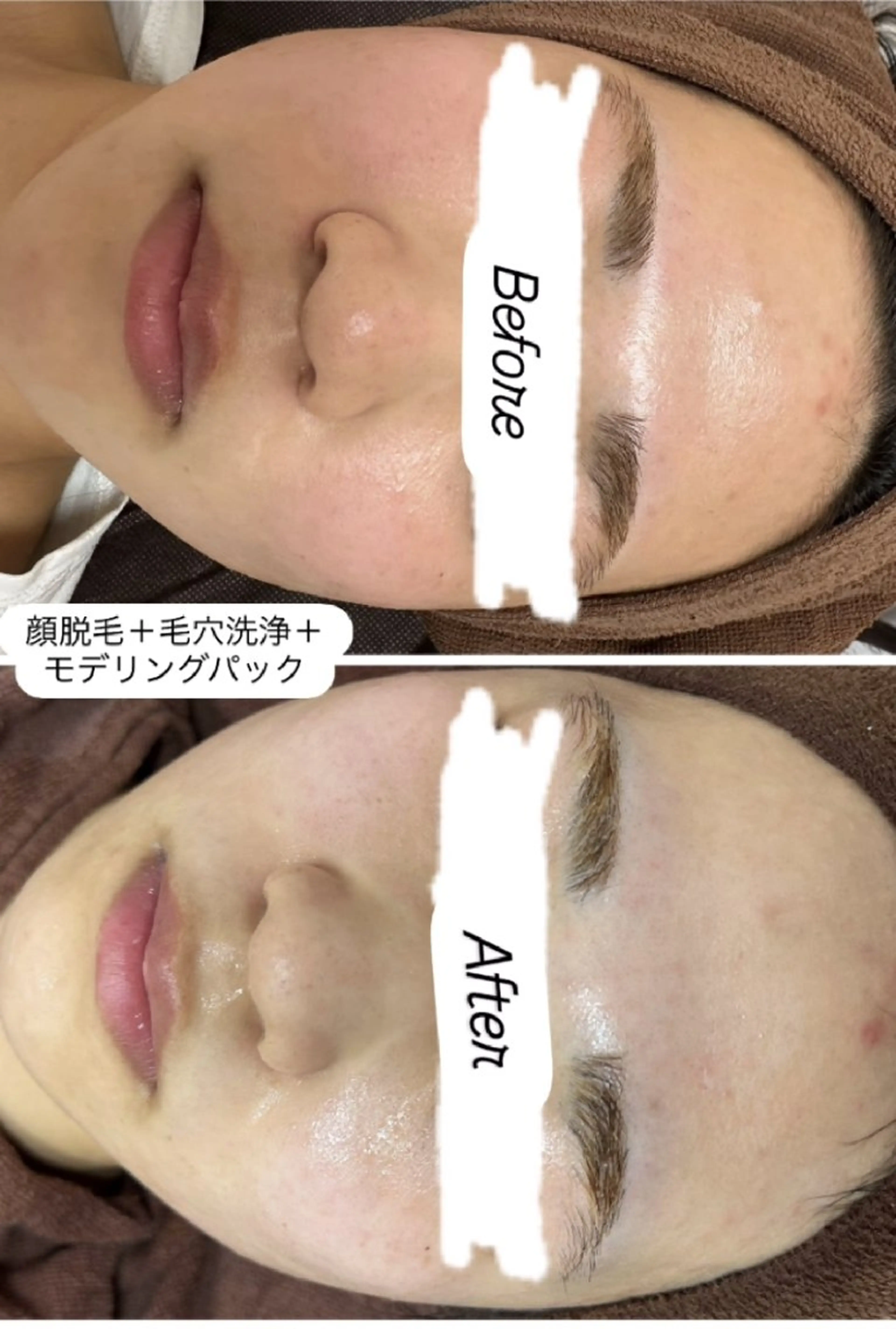 今日のイチオシ‼️毛穴の悩み撲滅‼️顔脱毛&毛穴洗浄✨️の写真