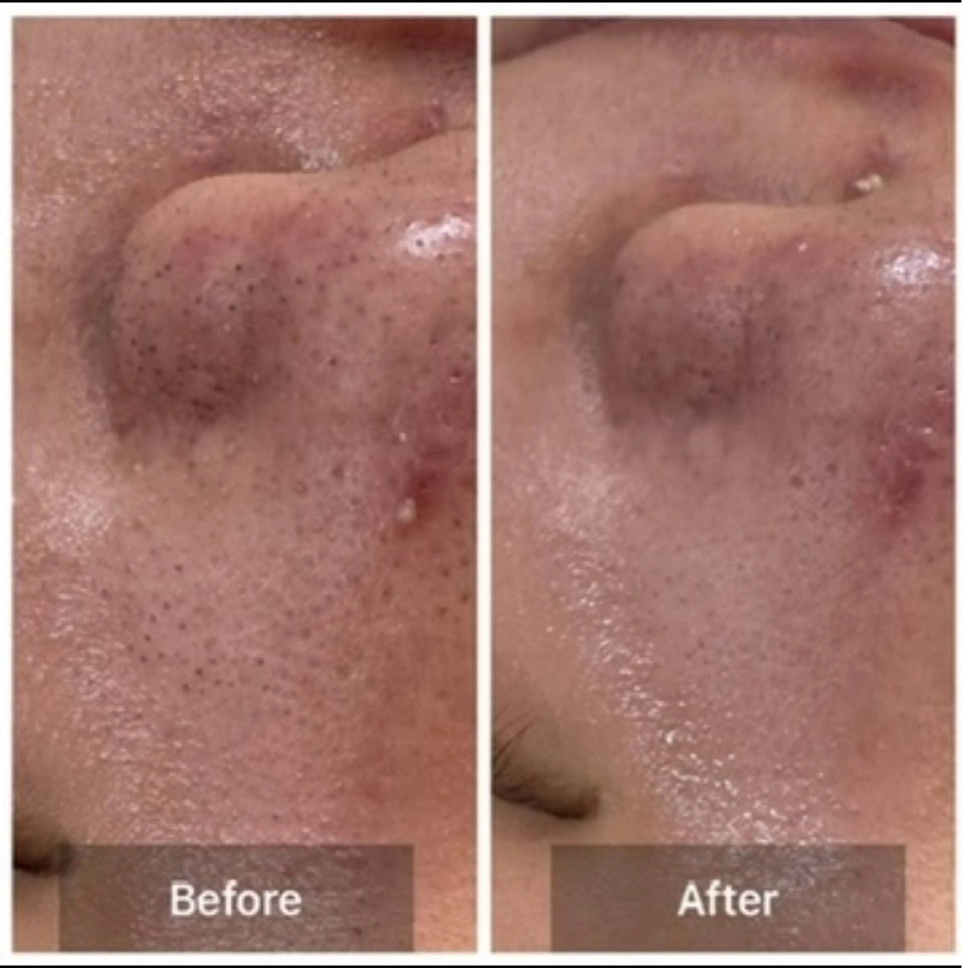 【男女OK】毛穴洗浄＋保湿フェイシャルの写真