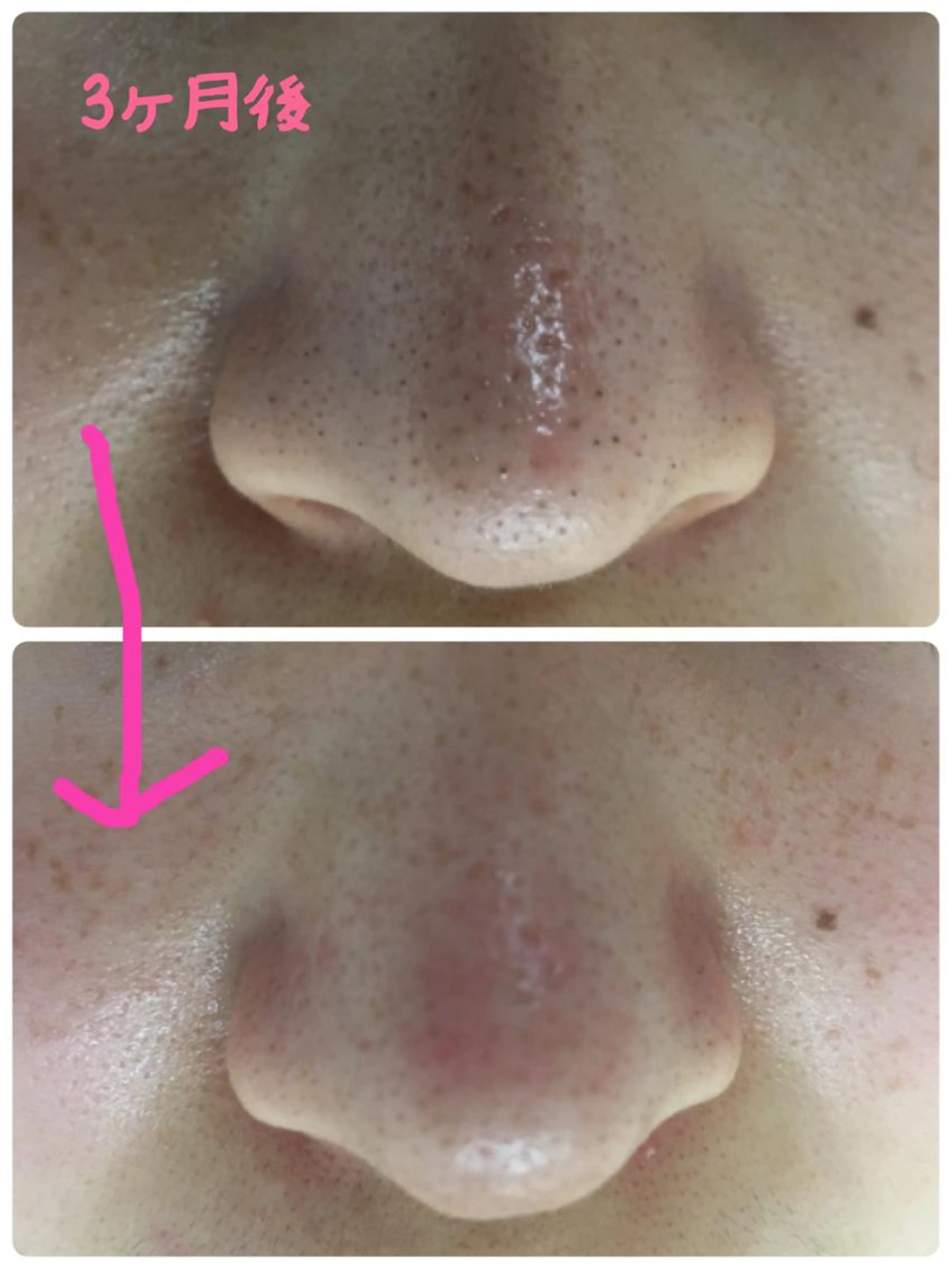 花粉、乾燥毛穴ケア６０分の写真