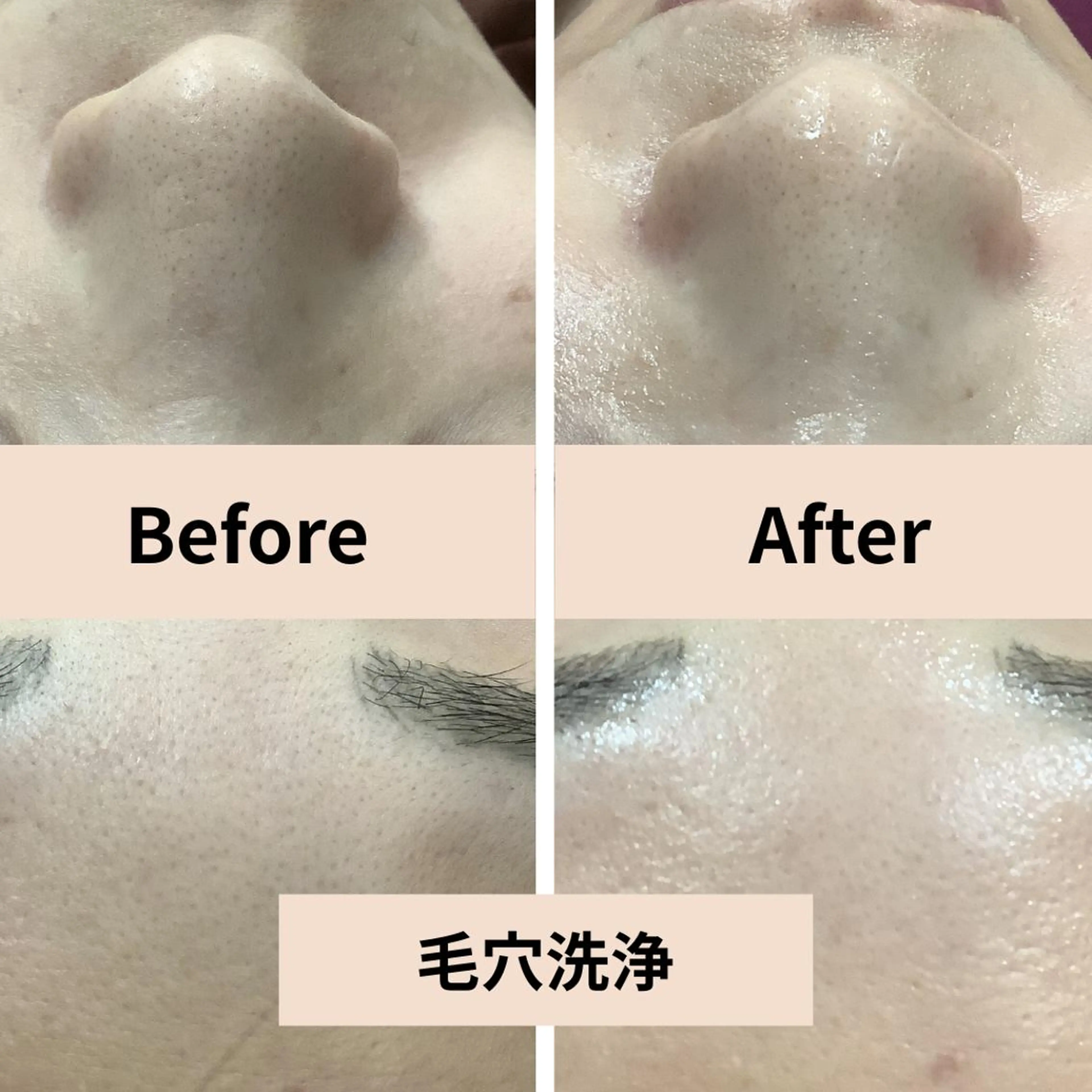 4月15日限定【毛穴洗浄/黒ずみ/ざらつき】毛穴すっきり洗浄+保湿ケアの写真