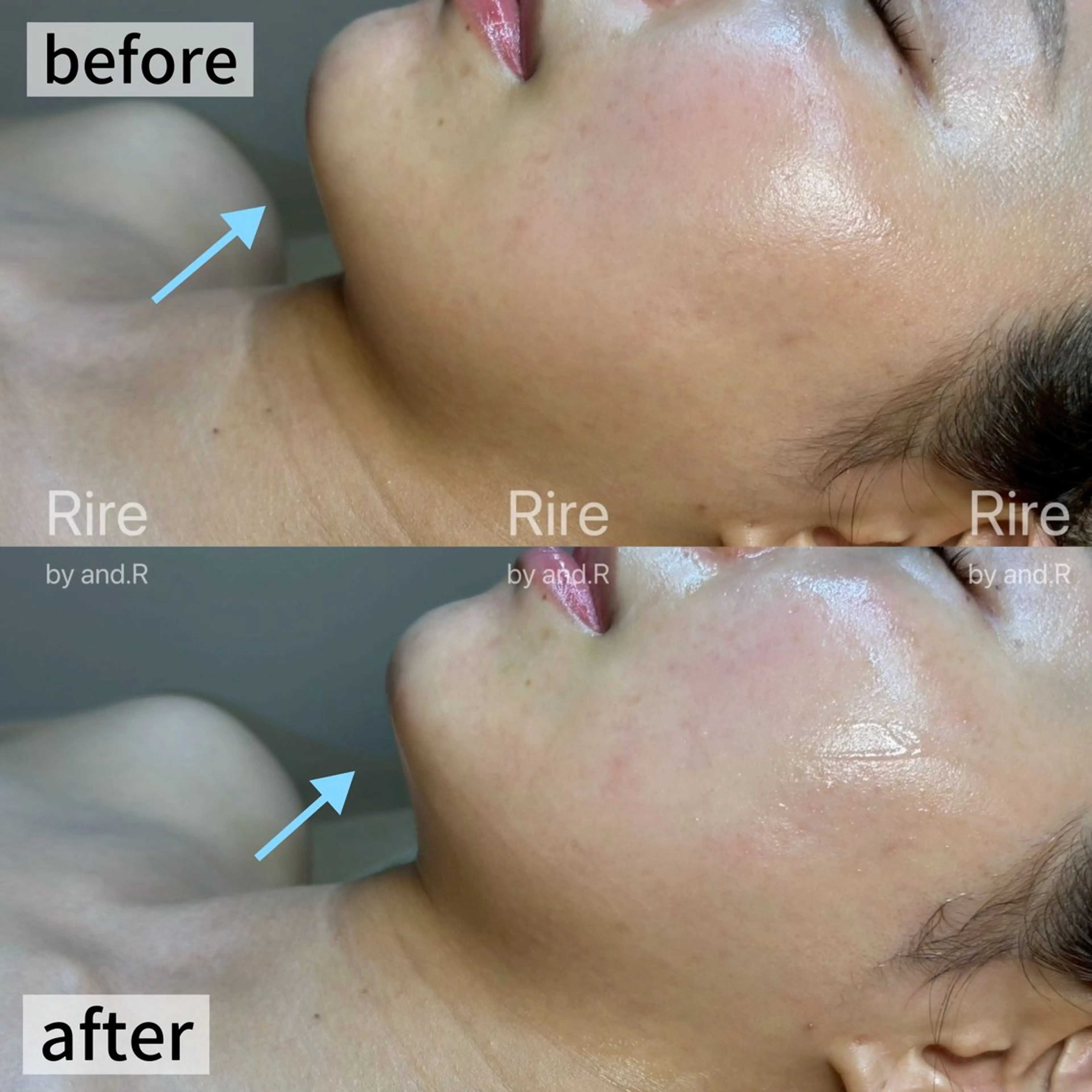 【緩んだ筋肉をググッと引き締め☆】リフトアップフェイシャル《プレミアム》の写真