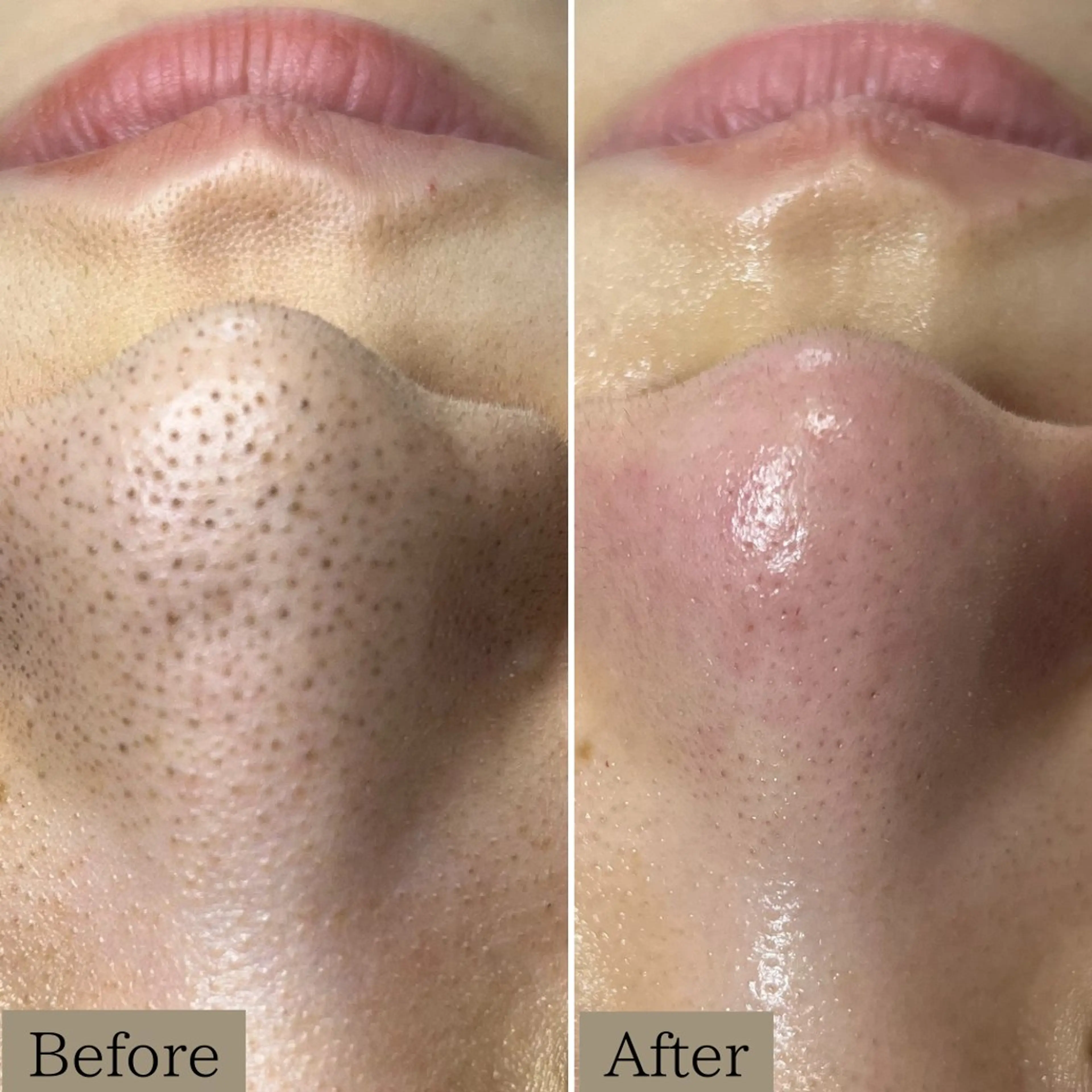 《1番人気》【黒ずみ毛穴ケア＆幹細胞ハーブピーリング】黒ずみゴワゴワ肌をつるん肌へ改善へ✨90分15800円の写真