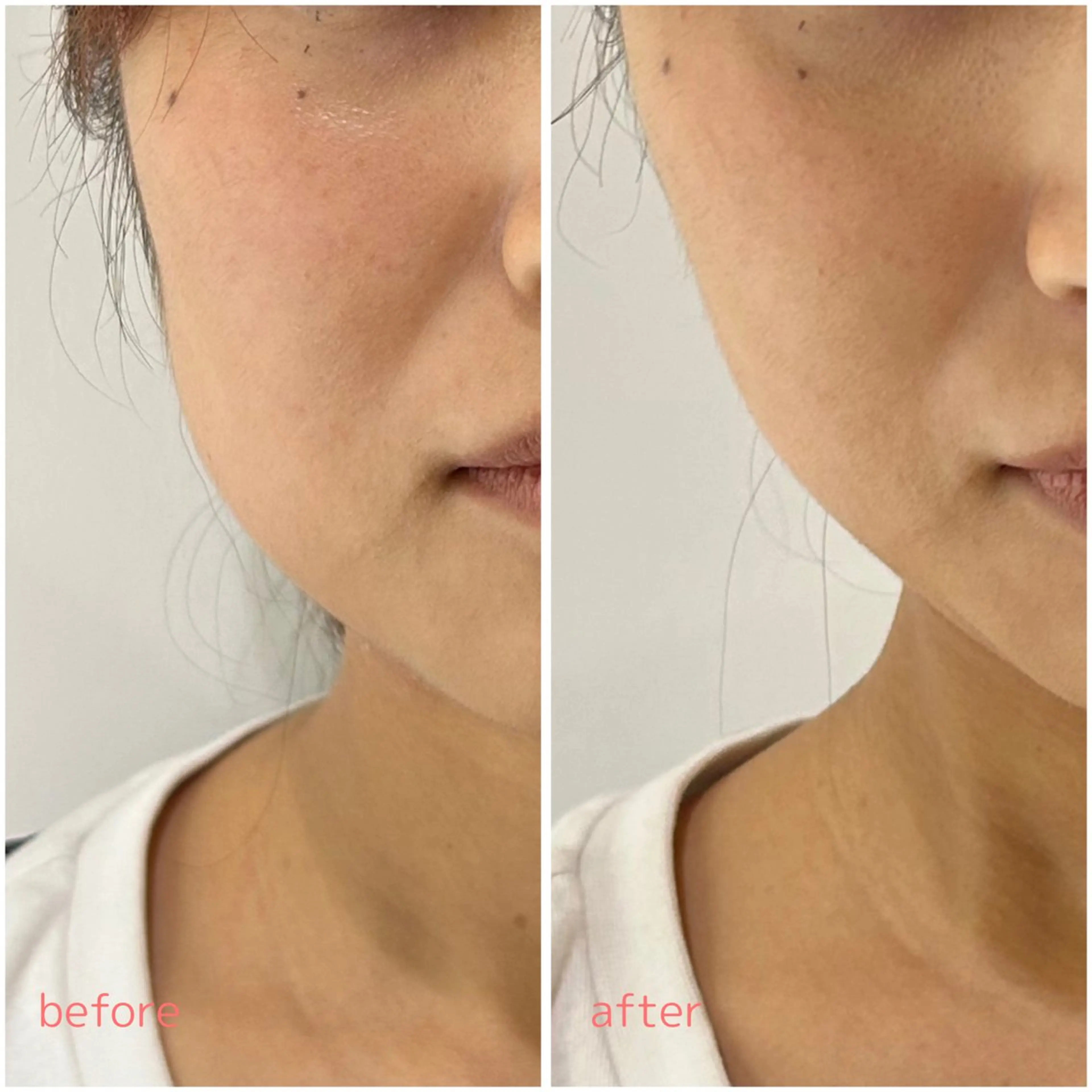 📍【相談無料／施術は¥4400​〜​】シミ・シワ・ニキビケアシミ・シワ・ニキビトータルケアのご相談はこちらからの写真