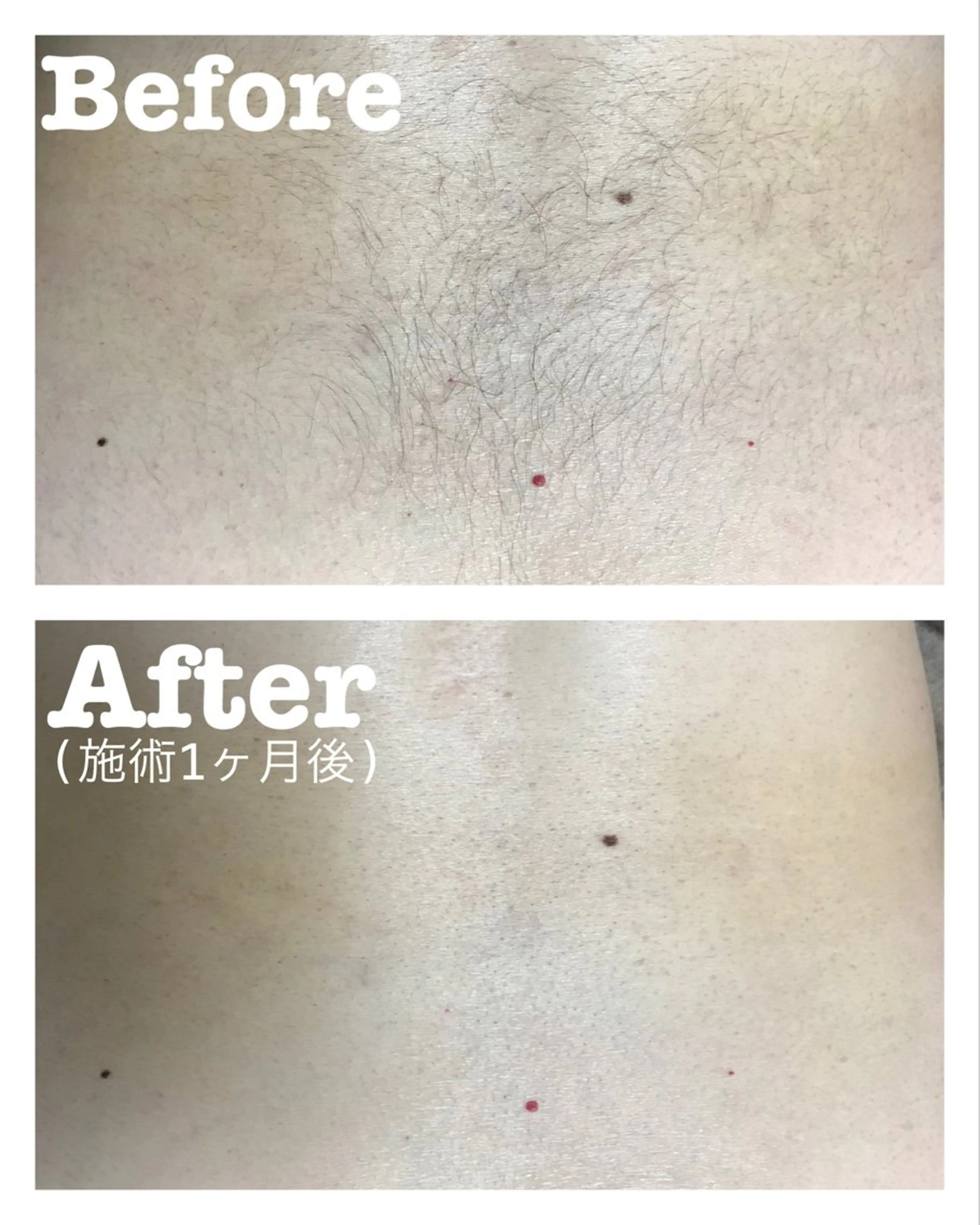 【全身光脱毛(お顔・VIO無し)】の写真