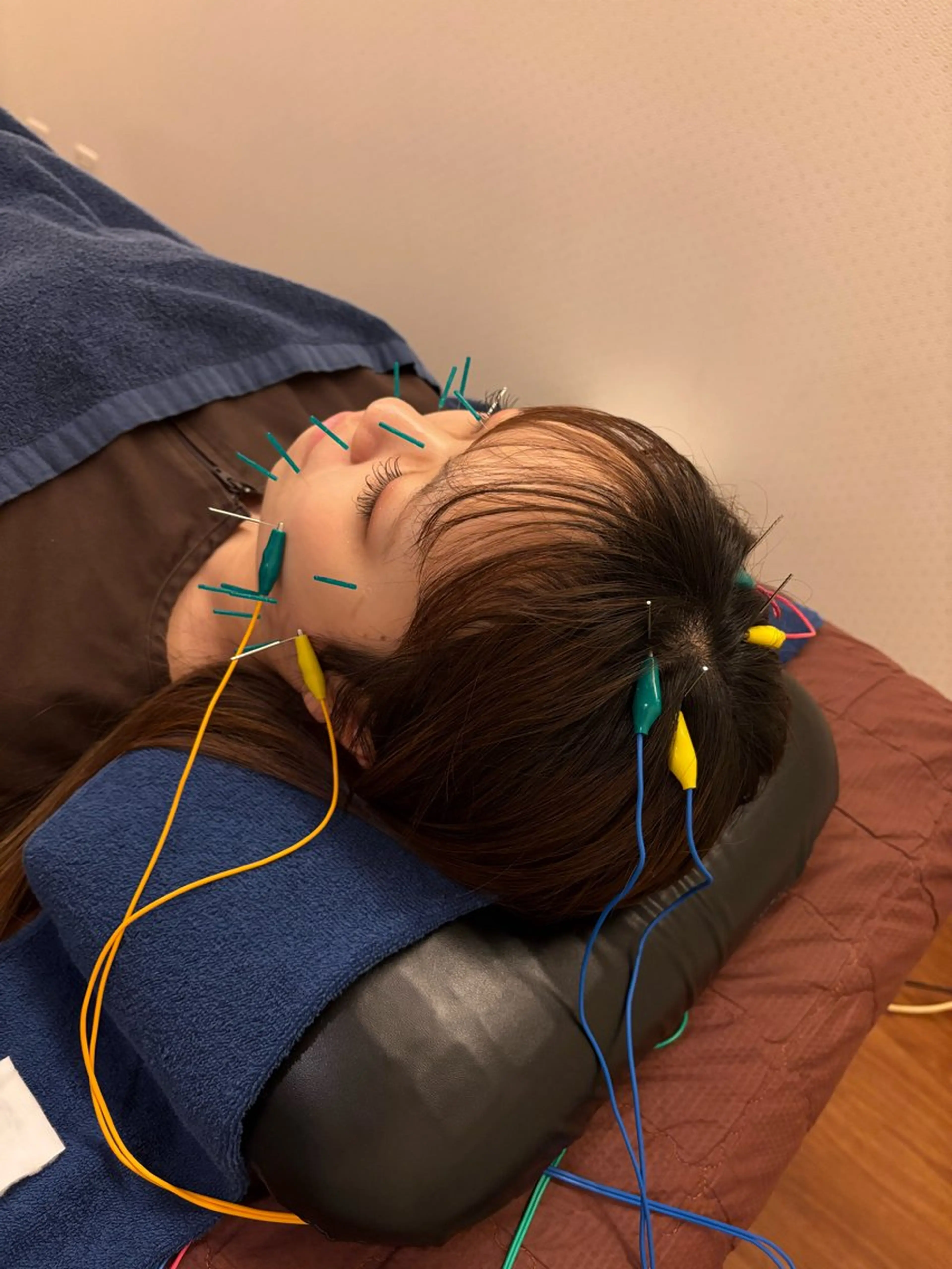 【当日限定】💆🏻‍♀️美容鍼+ヘッドマッサージ+整体マッサージ100分 (施術時間80分+カウンセリング20分)の写真