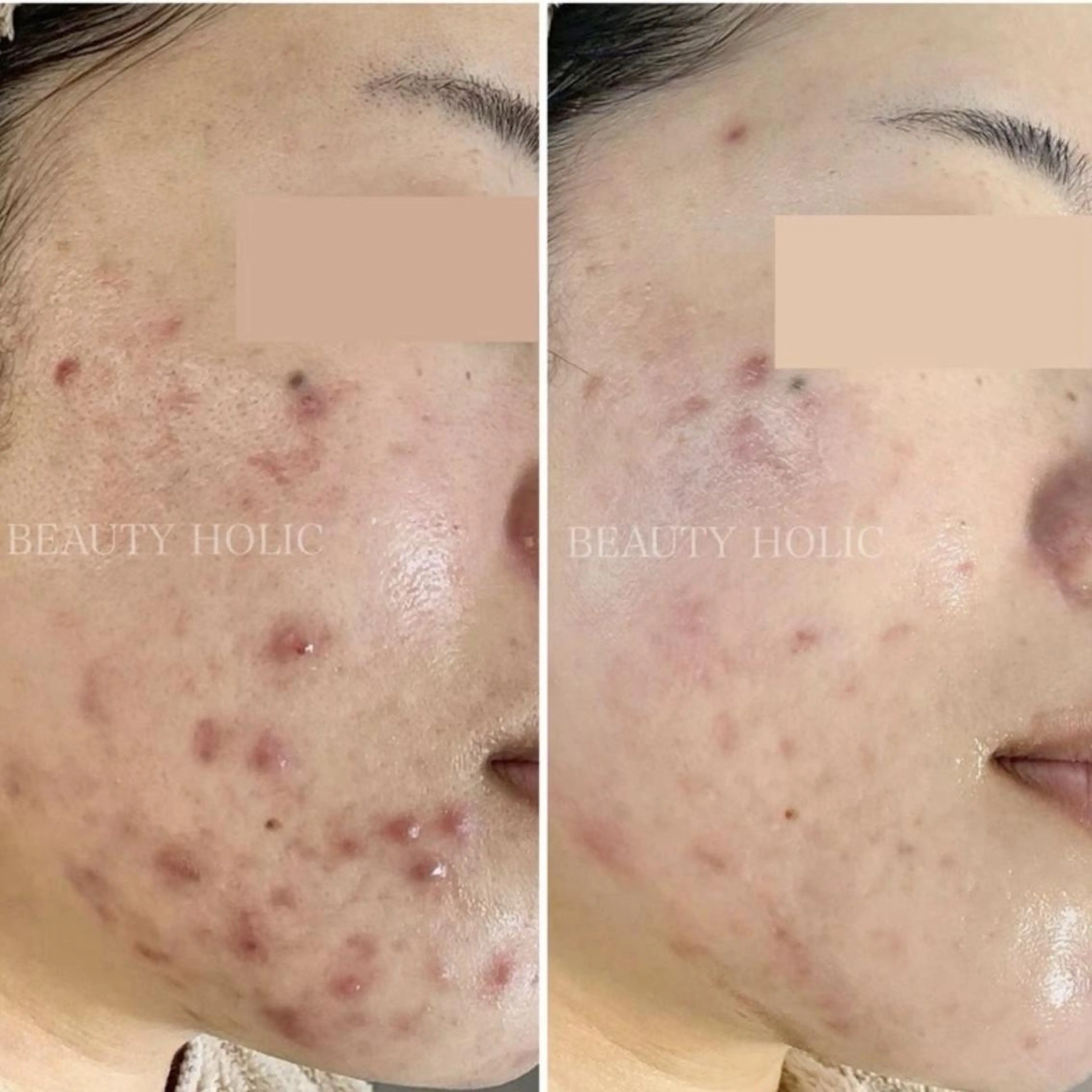 ニキビ・ 肌荒れ専門店のエステ・リラクイメージ