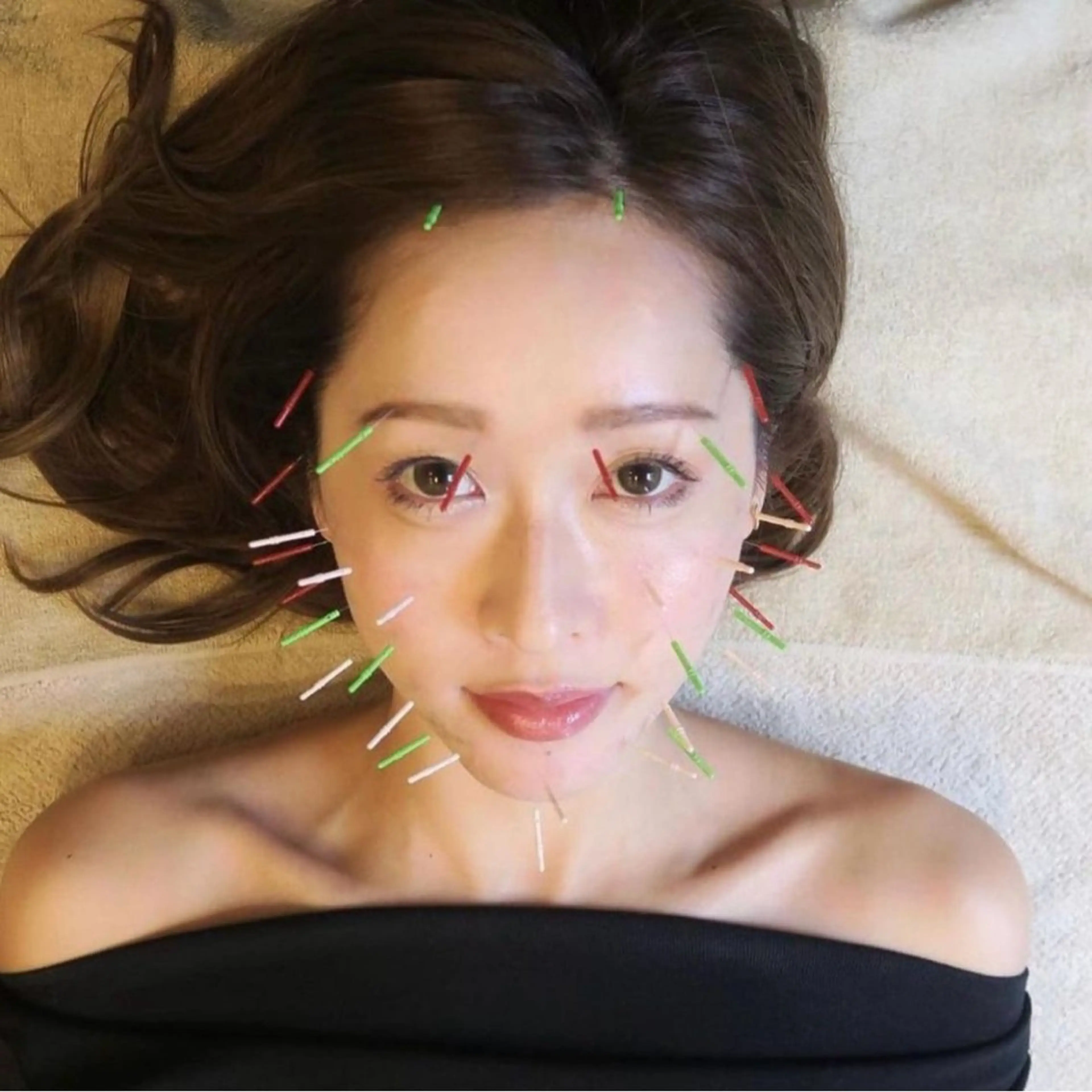 【フェイスラインをシュッとしたい方へ】オリジナル美容鍼の写真