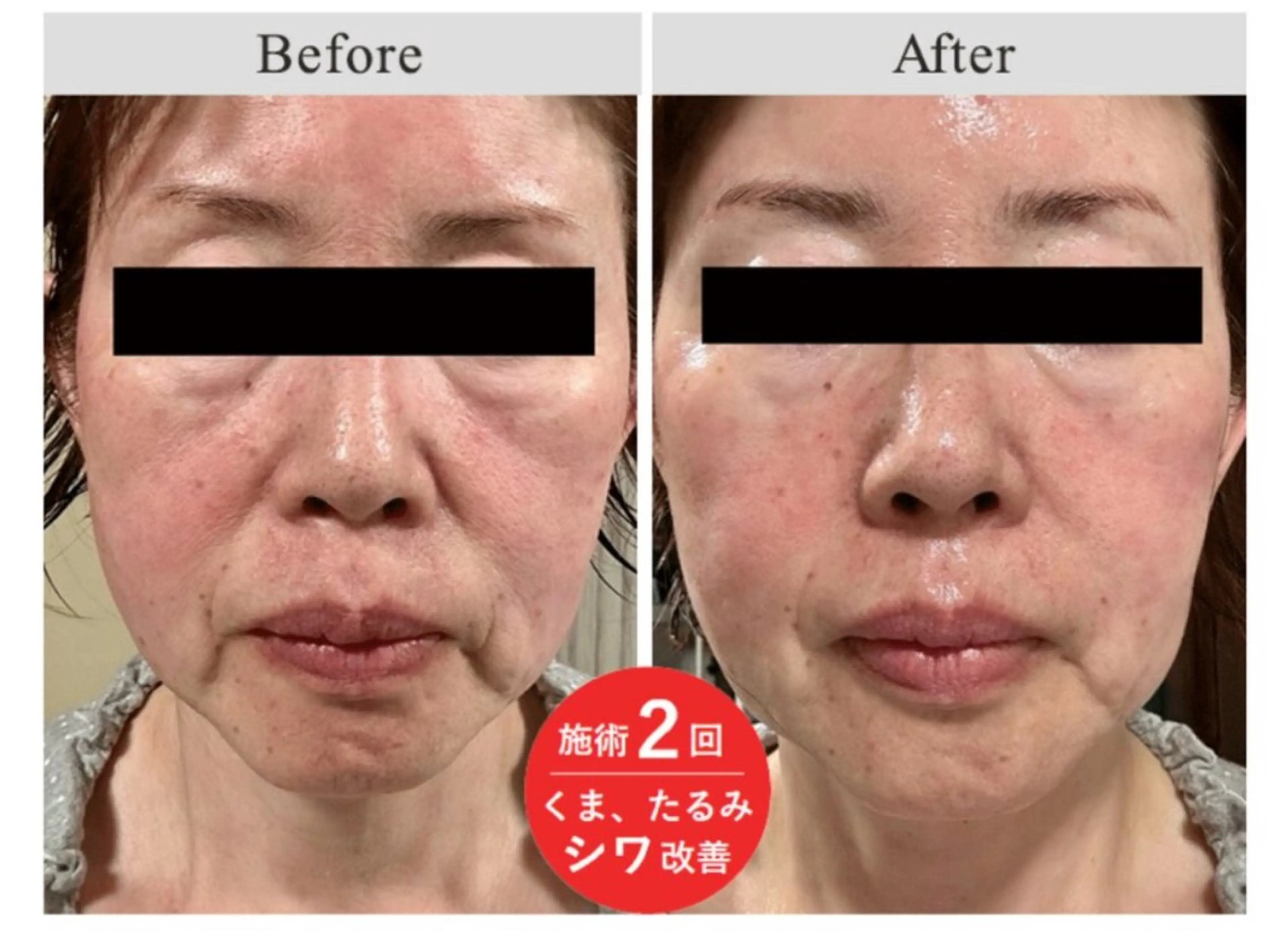 【40歳以上の方限定‼️】ビフォーアフター症例写真のご協力OKの方📷※希望日時リクエストをお願いいたします🙇♀️の写真