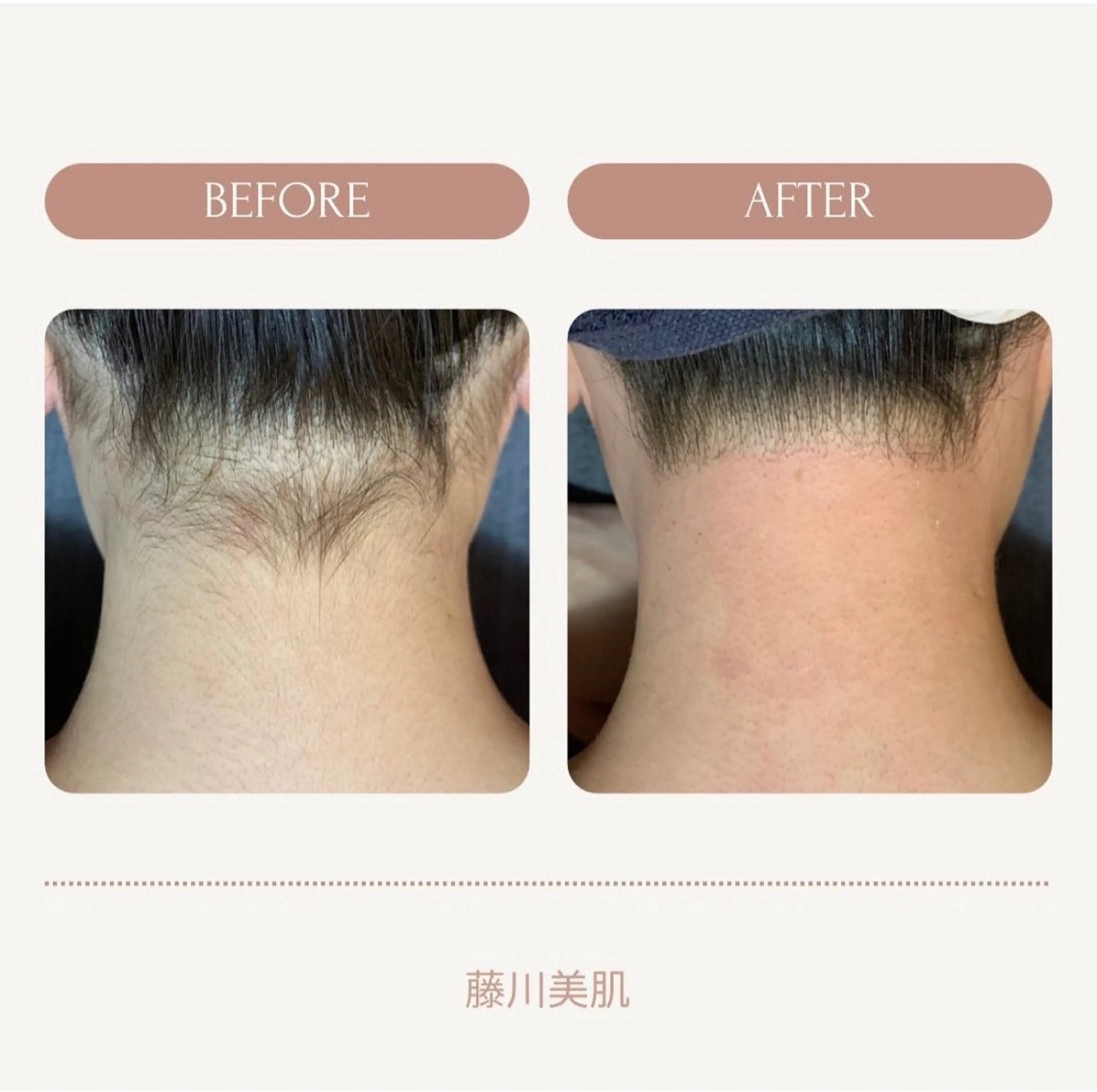 👱🏻‍♀️うなじワックス＆うなじ光脱毛👱🏻‍♀️の写真