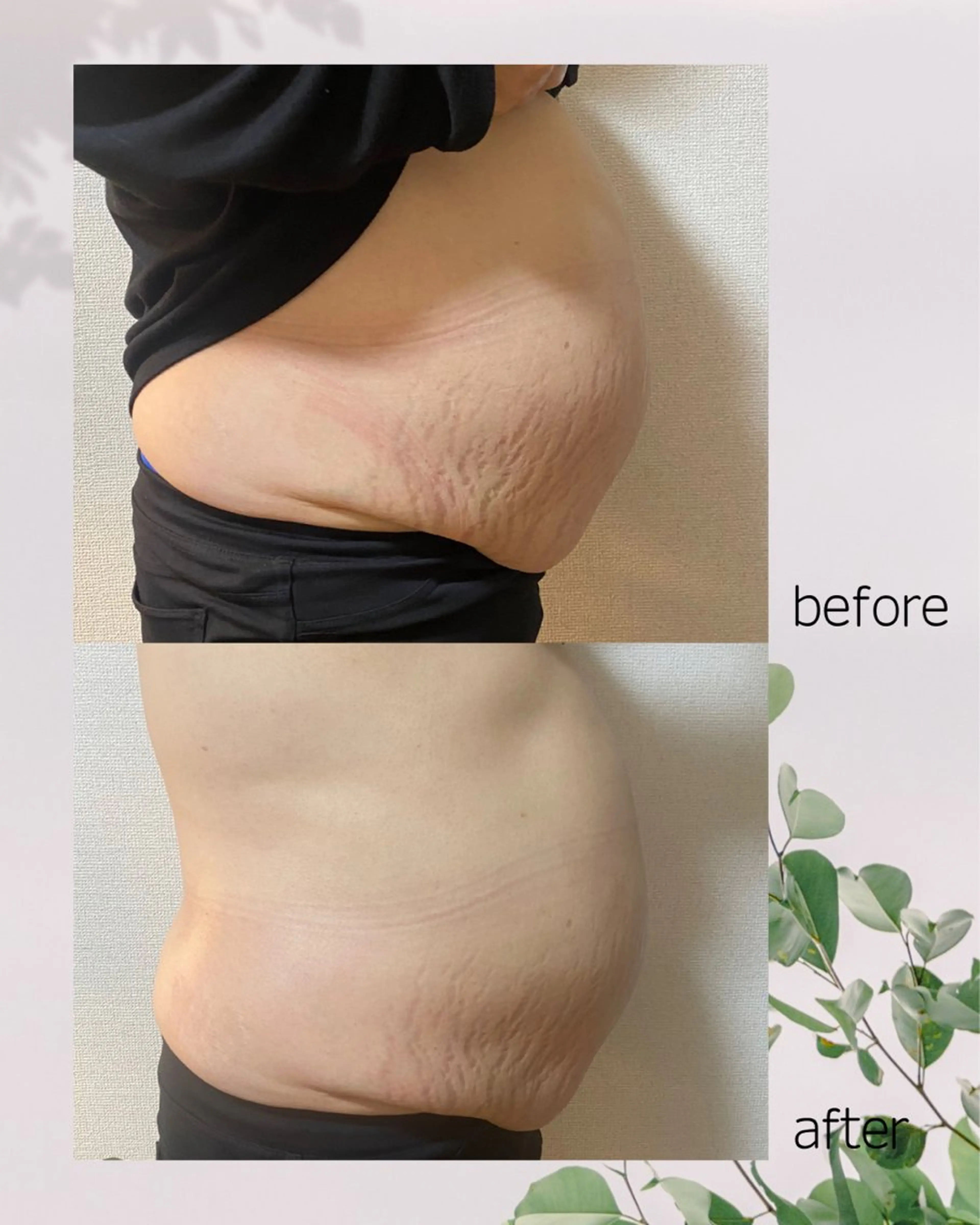 気になるお腹or太ももに◎『レットショットで溶解してスッキリ』全身リンパ付¥25000の写真