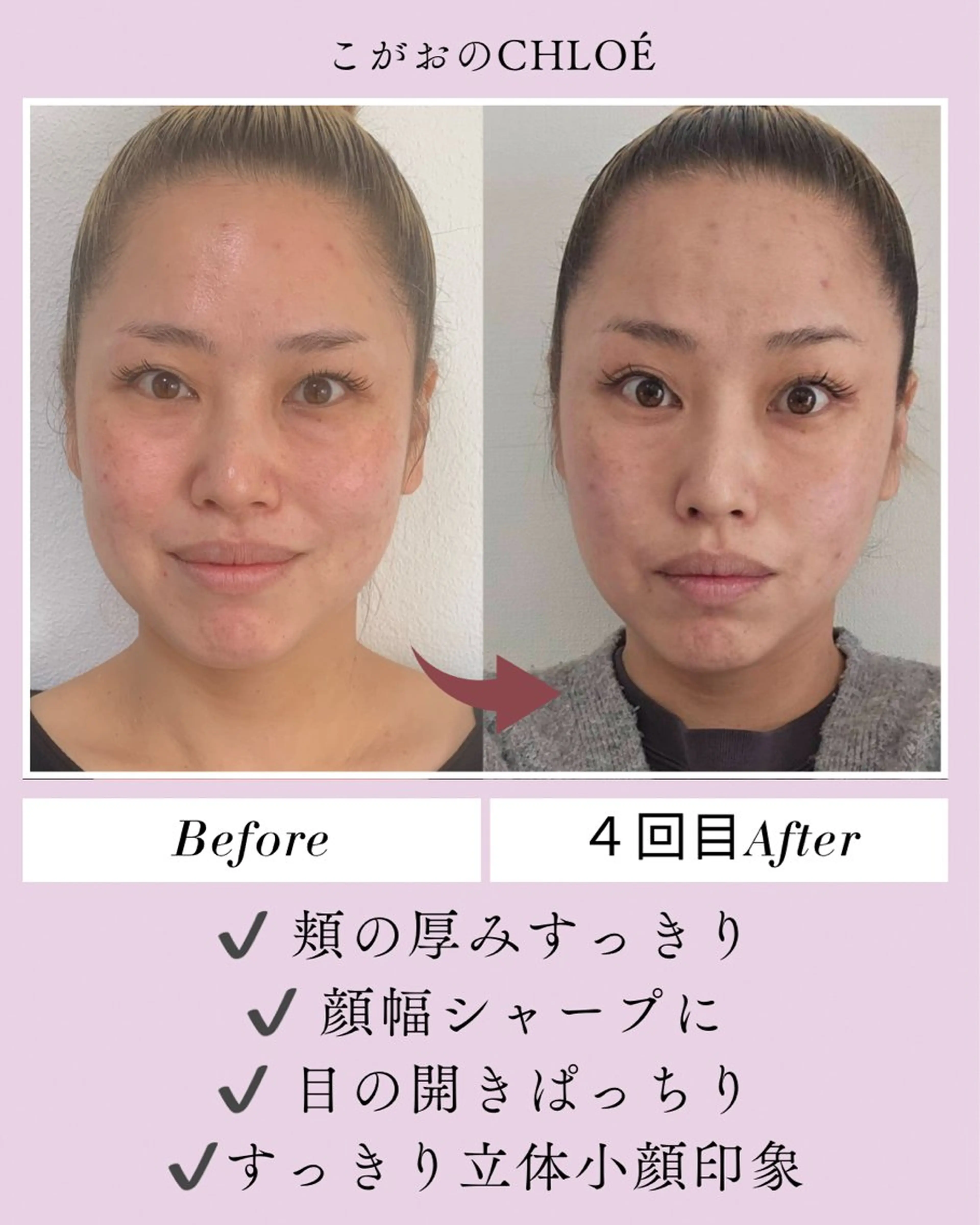 ⭐️小顔矯正モニター様募集⭐️目隠しナシで顔出しOKな方専用メニューの写真