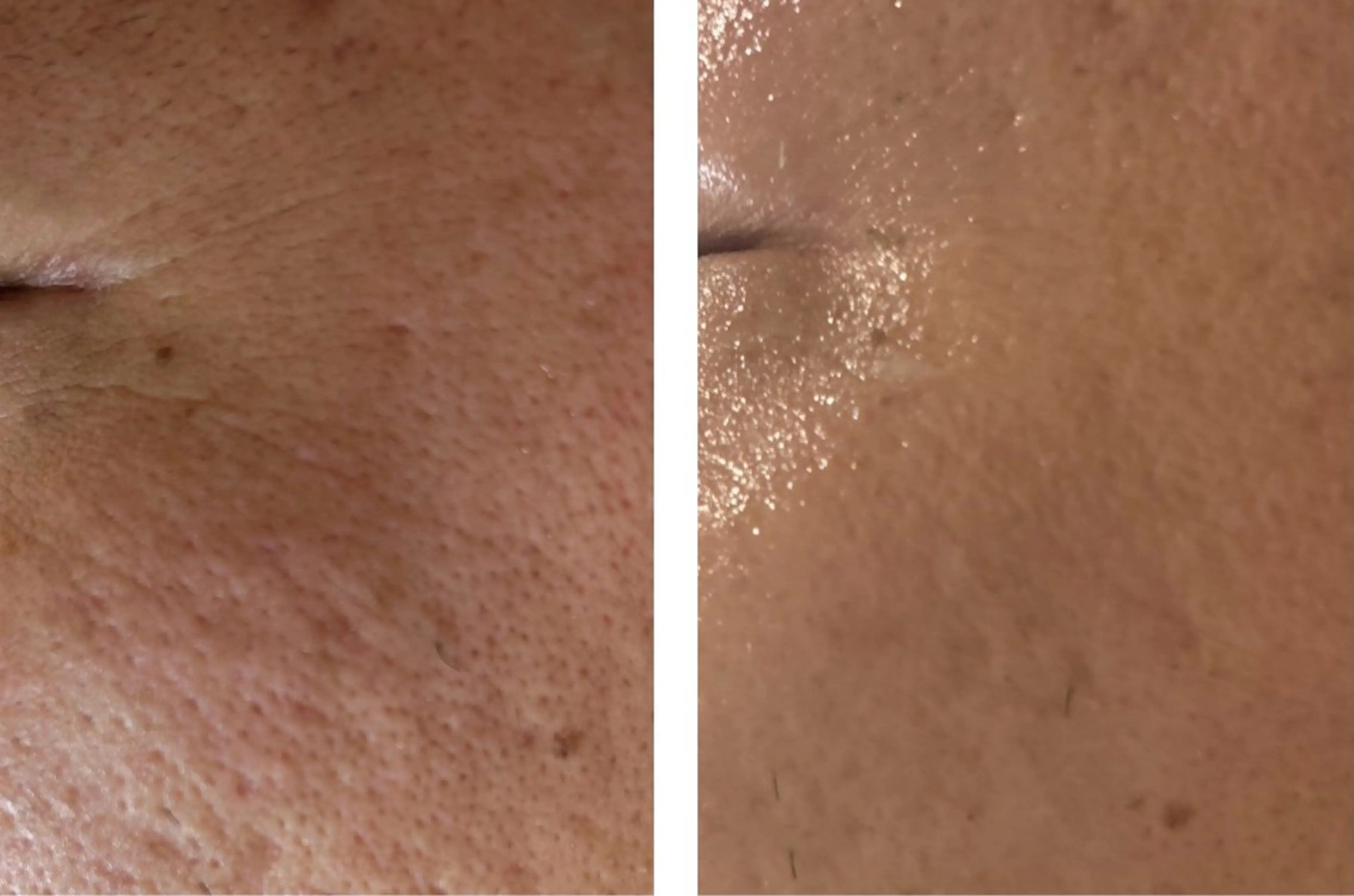 【シミ・シワ・ニキビ跡・開き毛穴】剥離なしハーブピーリング➕ハイドラ毛穴洗浄➕高濃度ビダミンC導入(美白パック付き)の写真