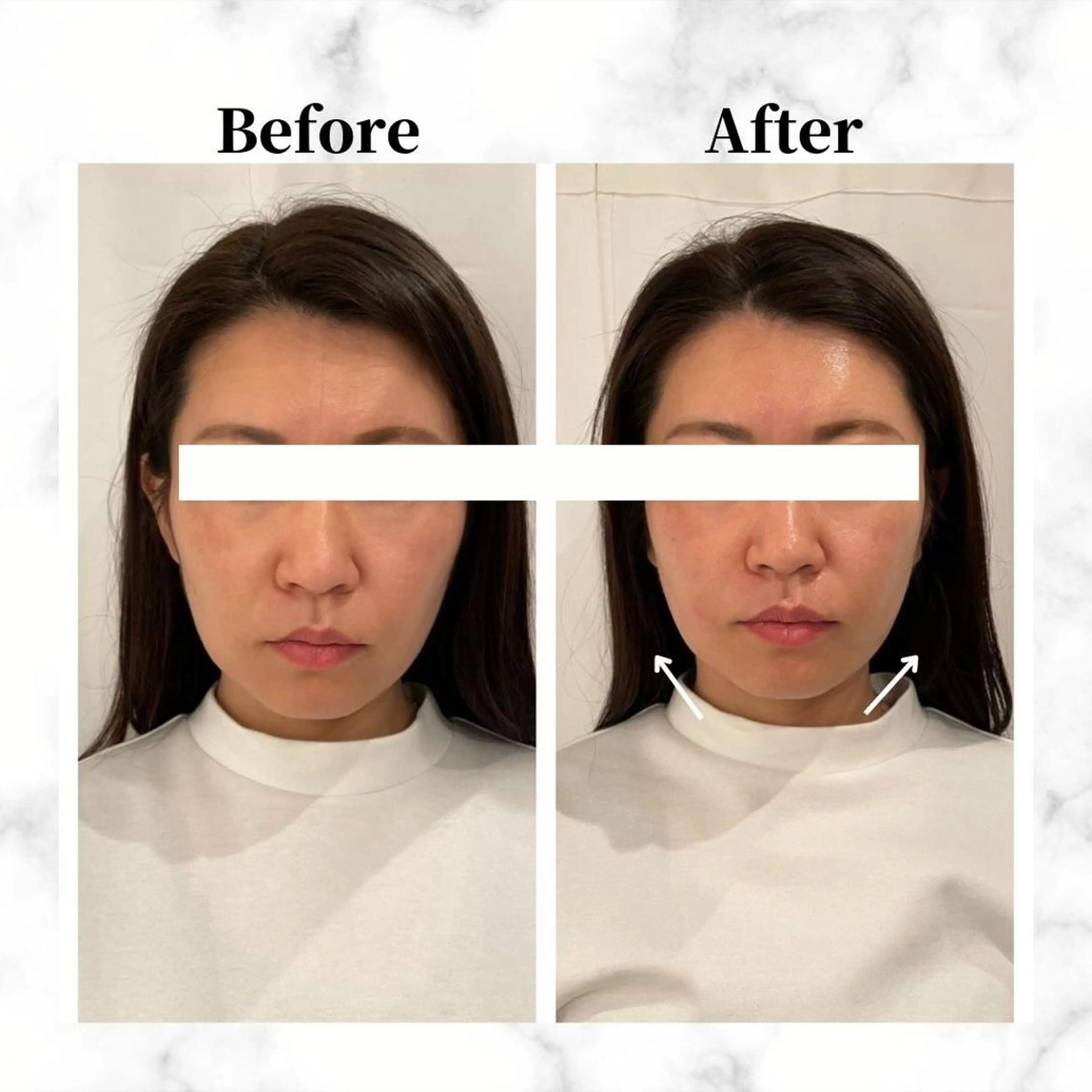 12Dハイフ💗 最強小顔のエステ・リラクイメージ