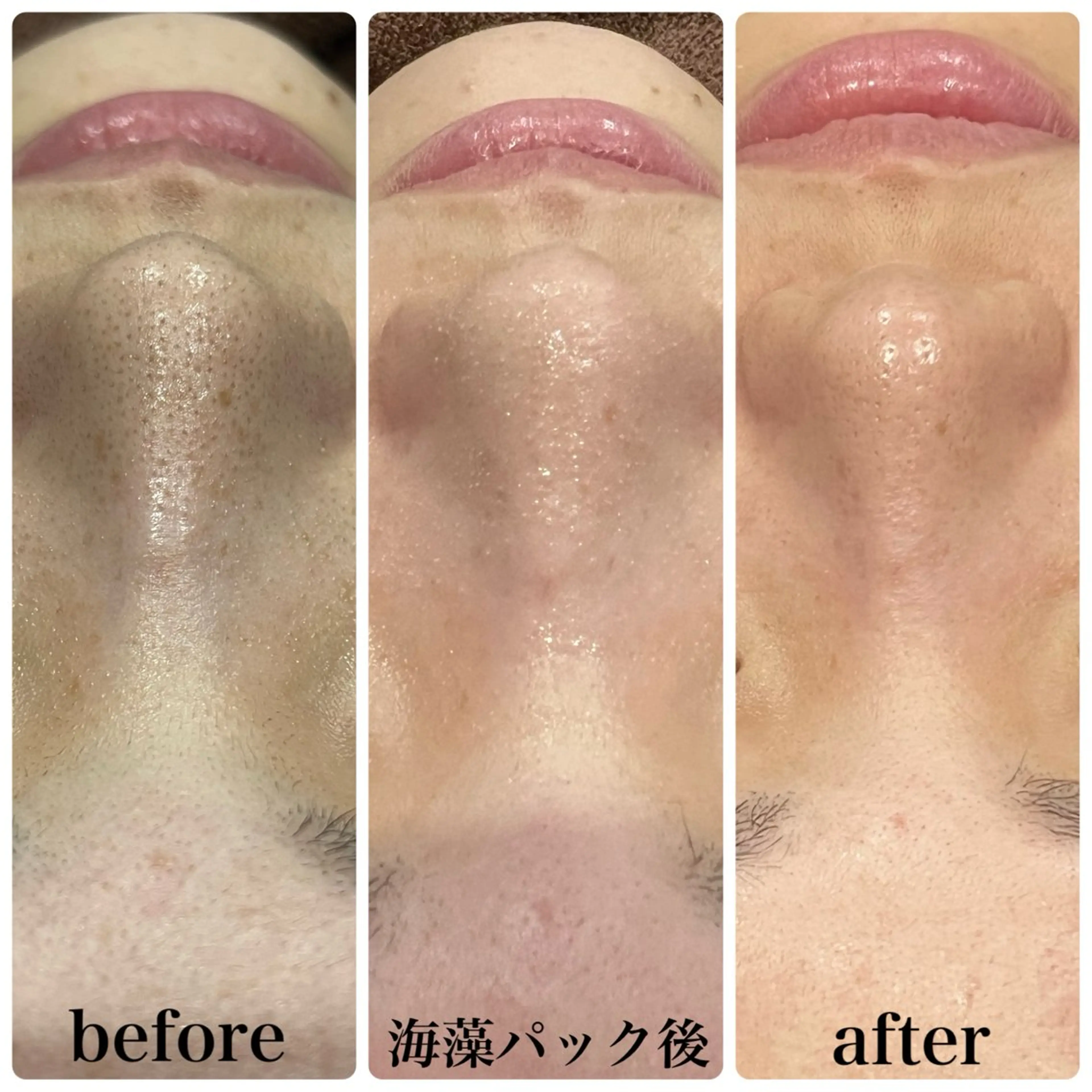 【男女/当日予約&来店限定/花粉や皮脂対策で透明肌へ】全顔3D毛穴洗浄¥4,980の写真