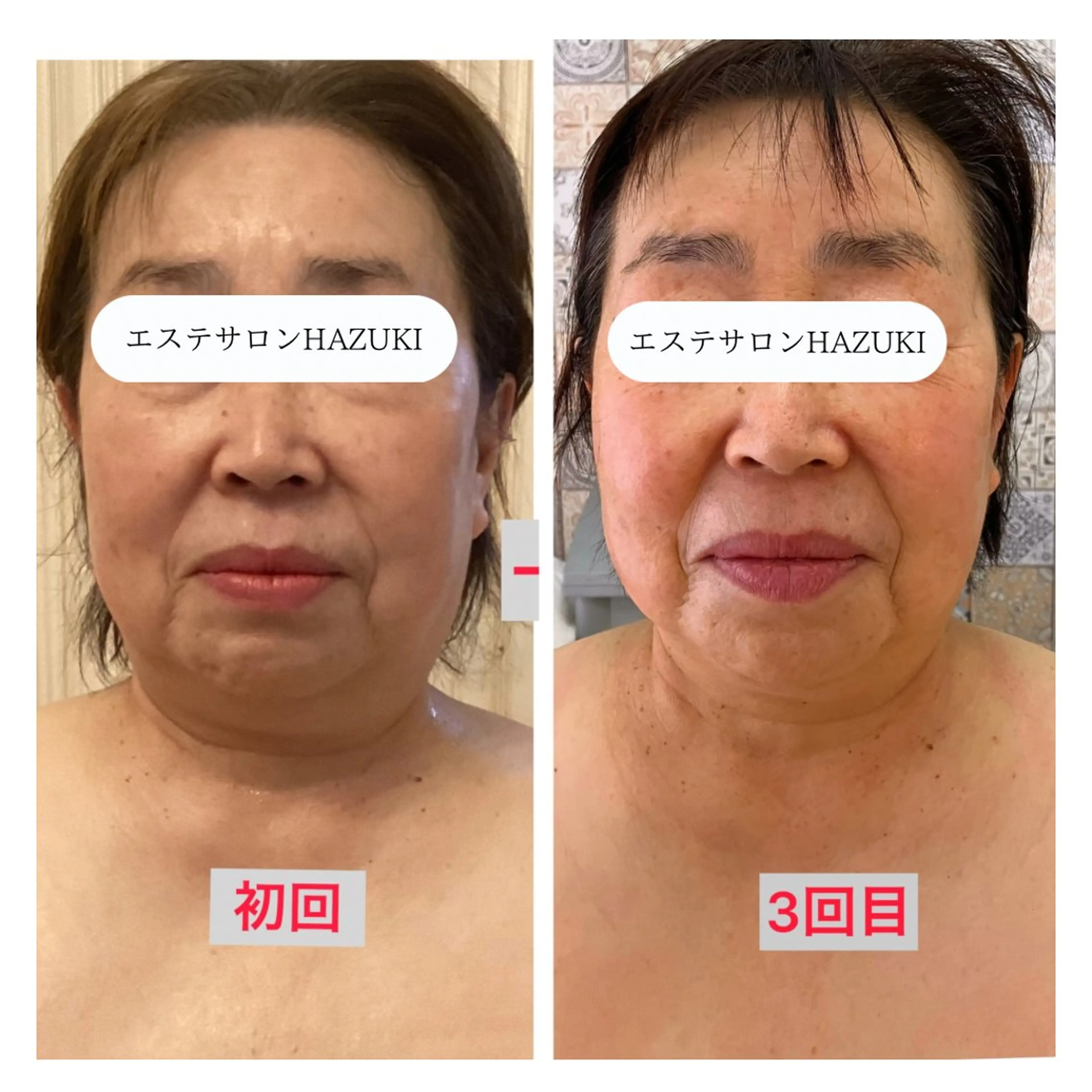 その他 たるみ改善小顔エステ 堀葉月のその他イメージ