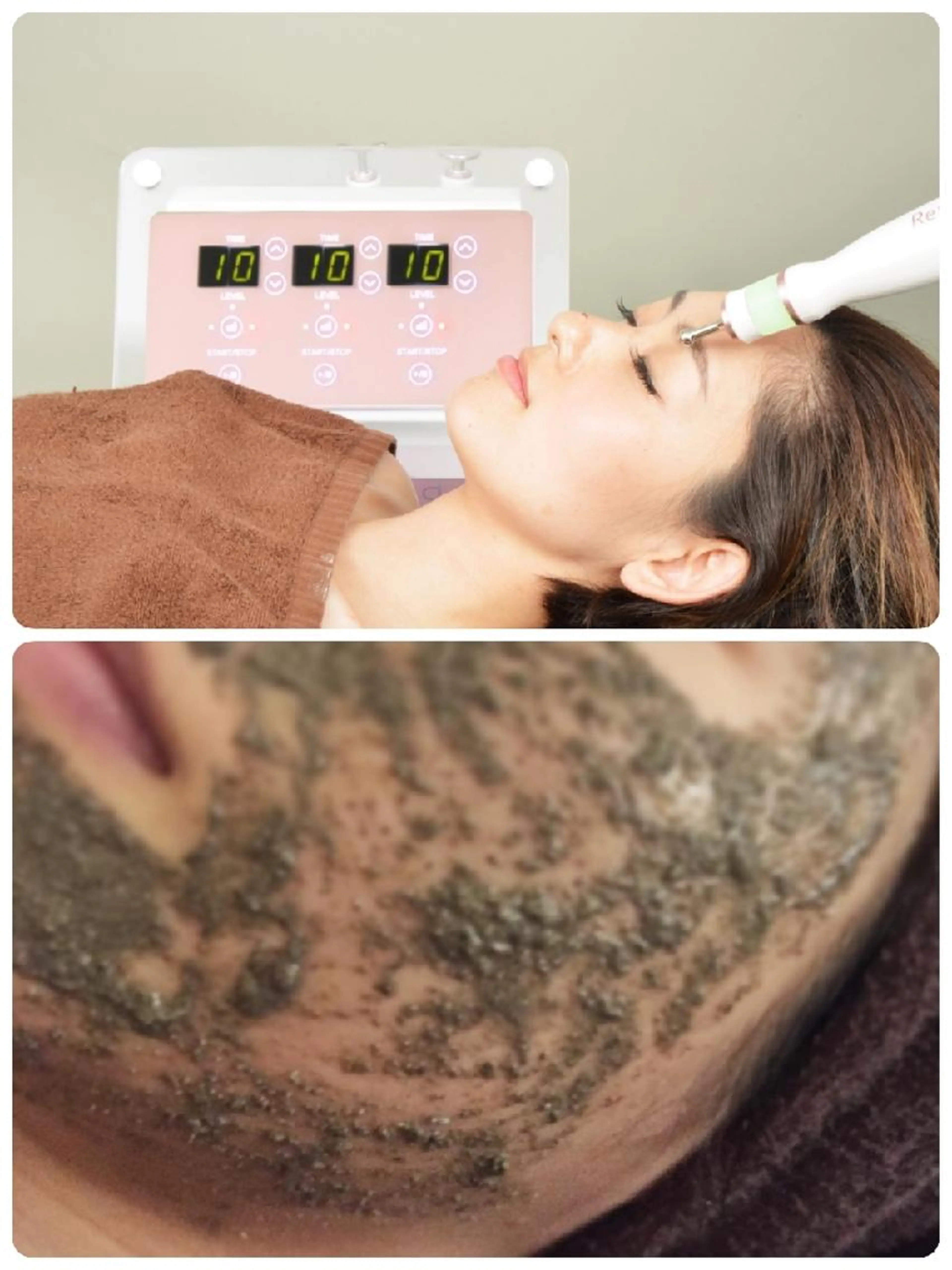 【最強ケア】プラズマシャワー×ハーブピーリング×ナチュラル整形®️(頭皮、ネック、デコルテ、背中)　お肌診断付き❗の写真