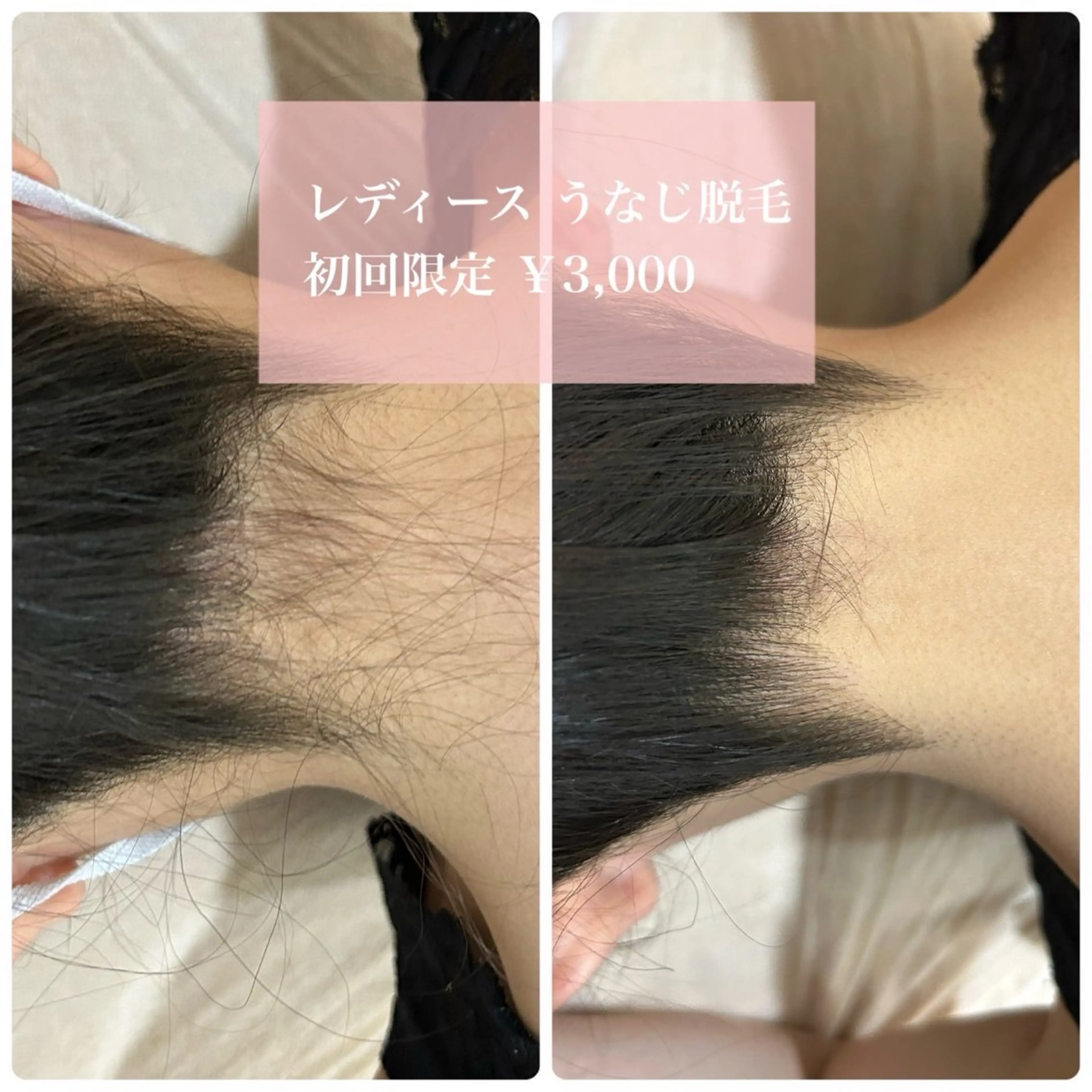 ［女性］🤍うなじ脱毛の写真