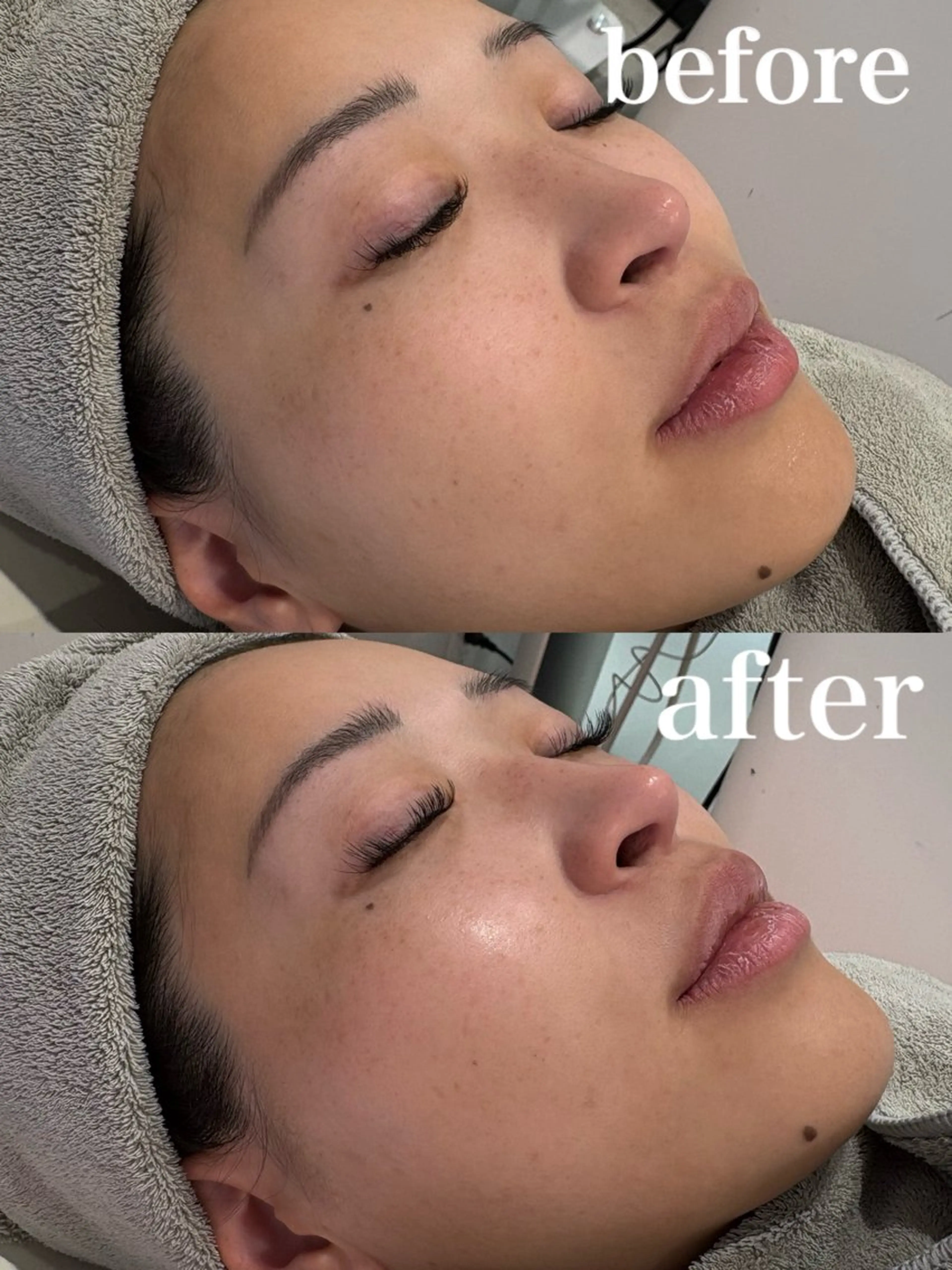 【美肌×小顔】韓国肌管理水光ララピール&エレクトロポレーション導入✨小顔矯正付🕊️の写真