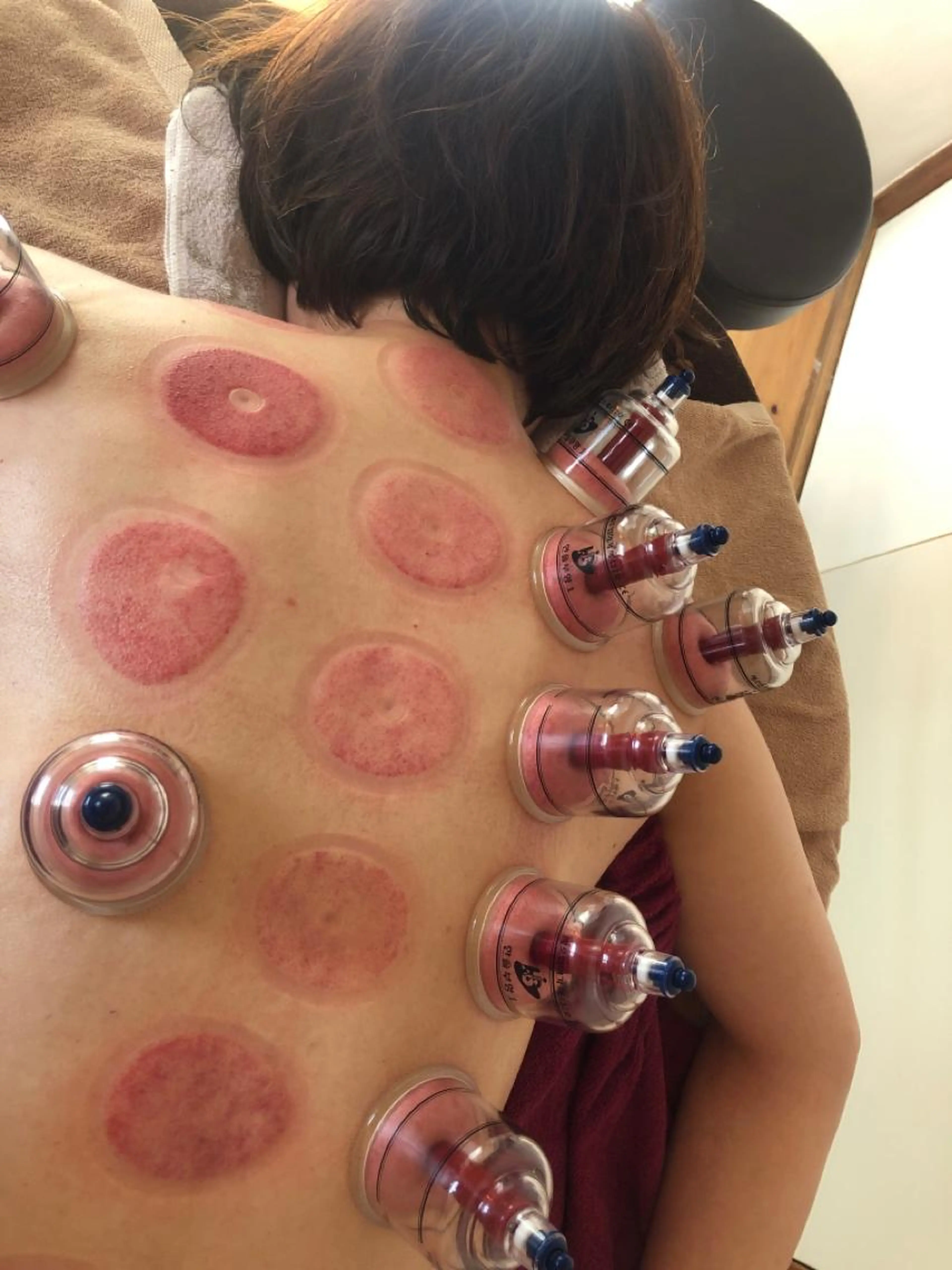 吸い玉デトックス60分の写真