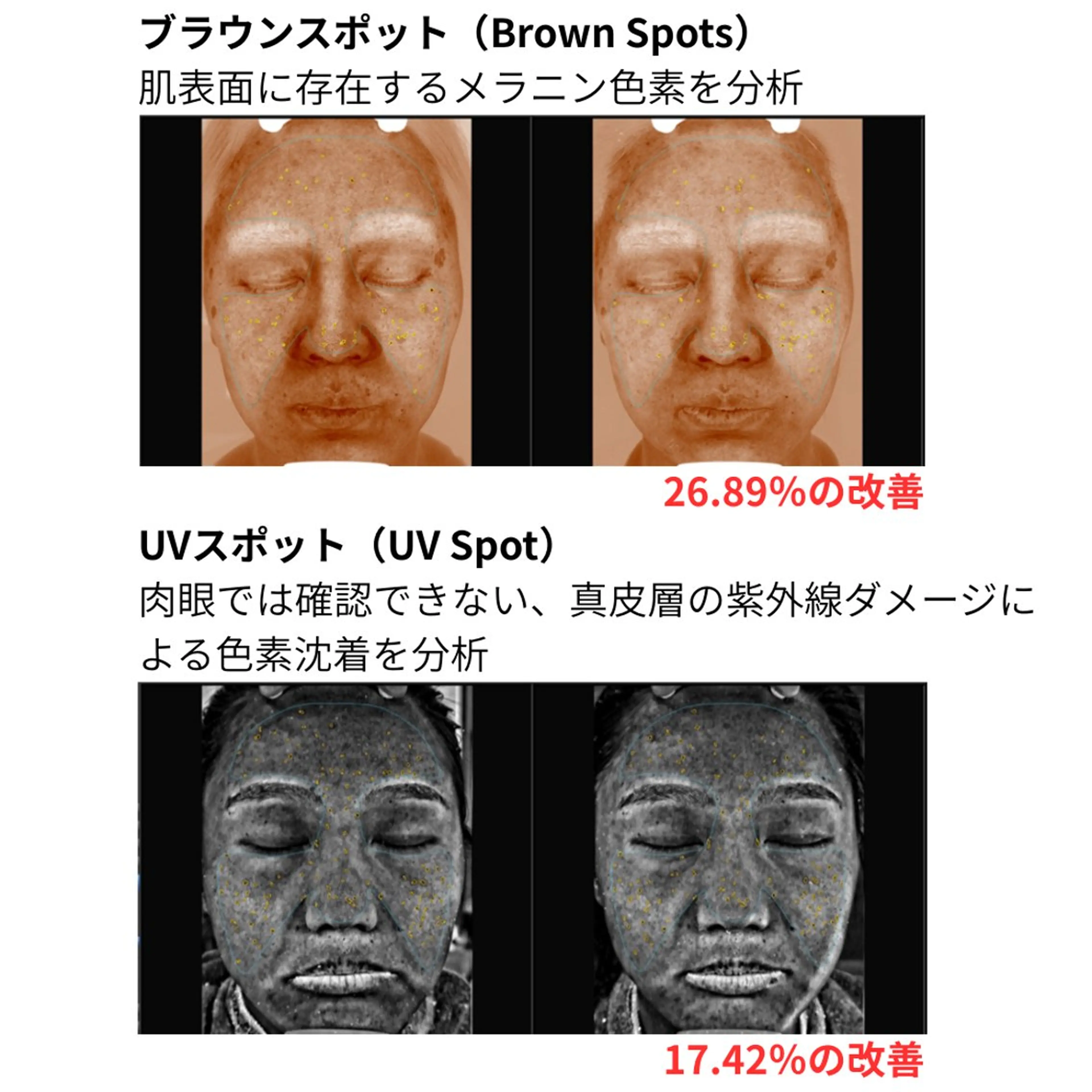 くすみ　色素沈着　最強　スピキュールピーリングの写真