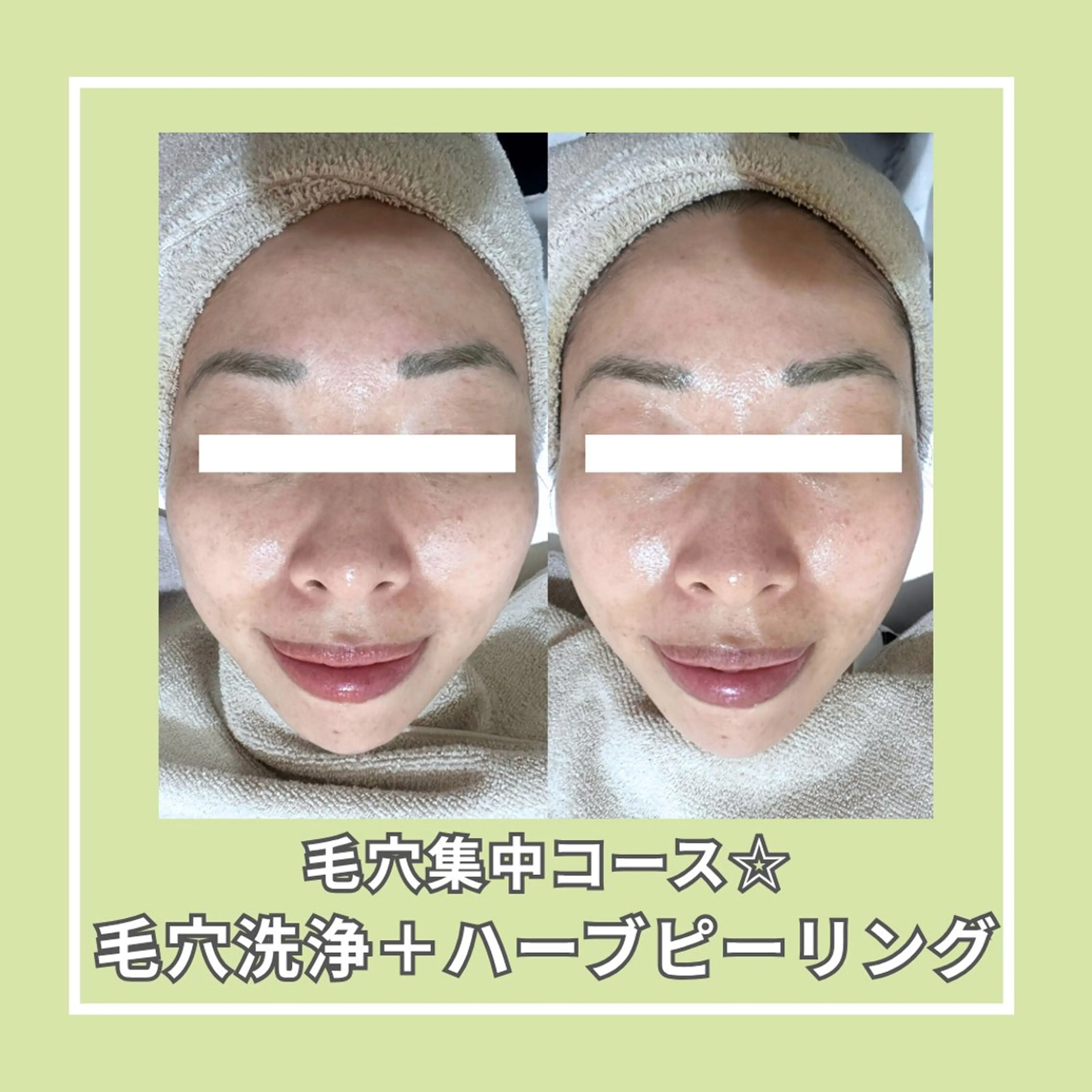 エステ |ピーリング・毛穴| soina神楽坂のエステ・リラクイメージ