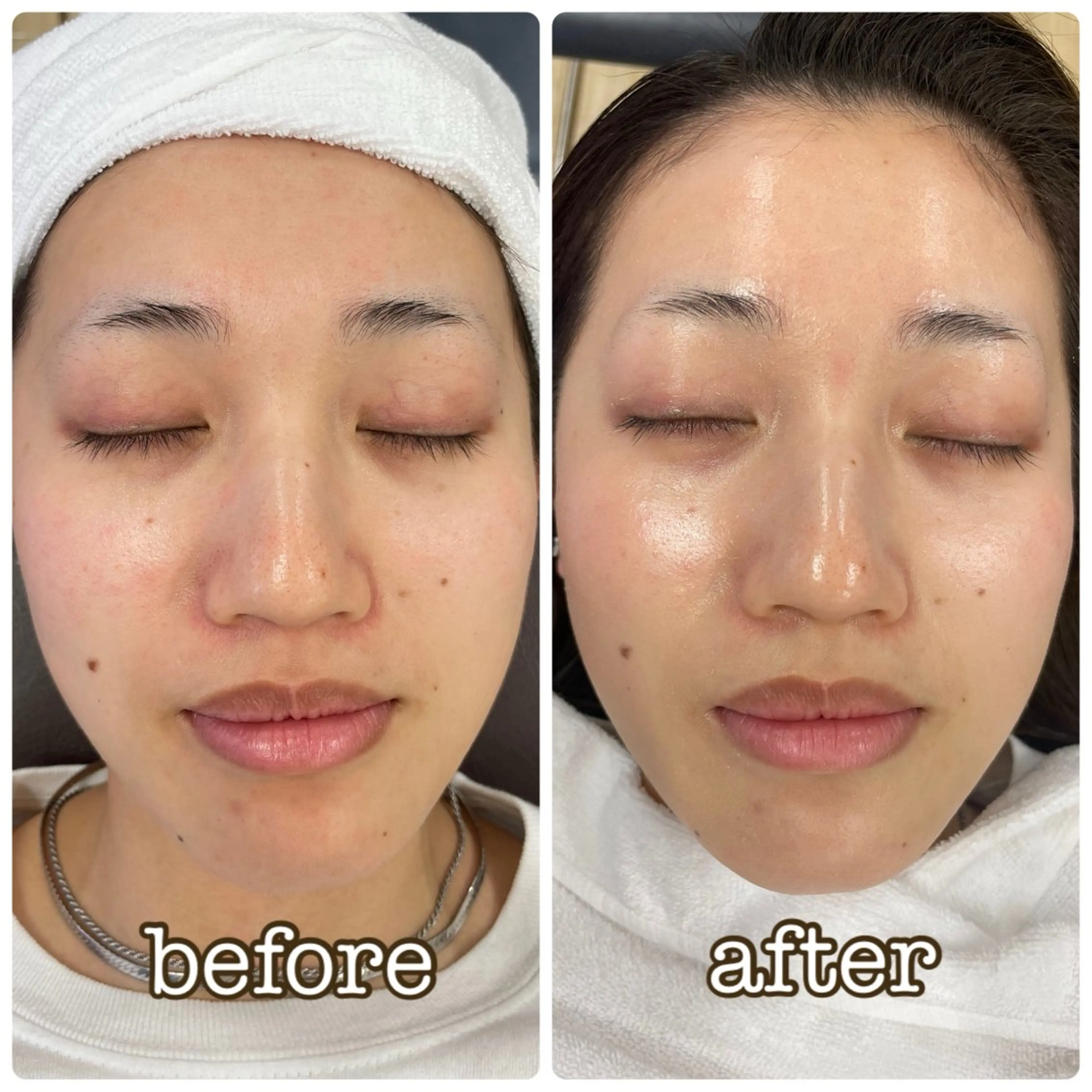 【角質・産毛除去で滑らかな肌へ】メイクアップシェービング2回目の写真