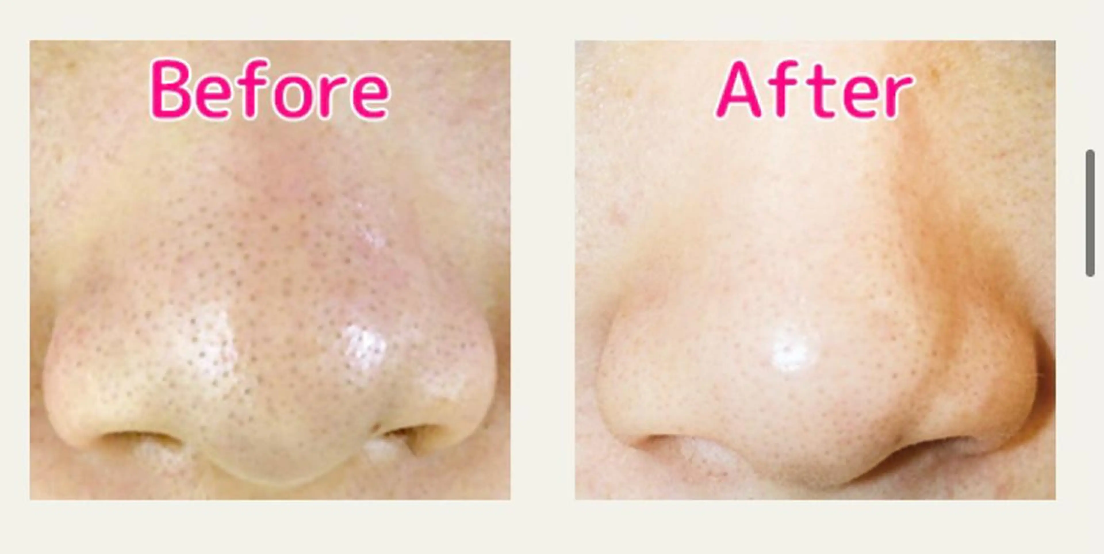 くすみのない滑らかなお肌に✨毛穴の黒ずみ、ざらつき、肌荒れにお悩みの方おすすめです！男性にも大人気メニューです！の写真