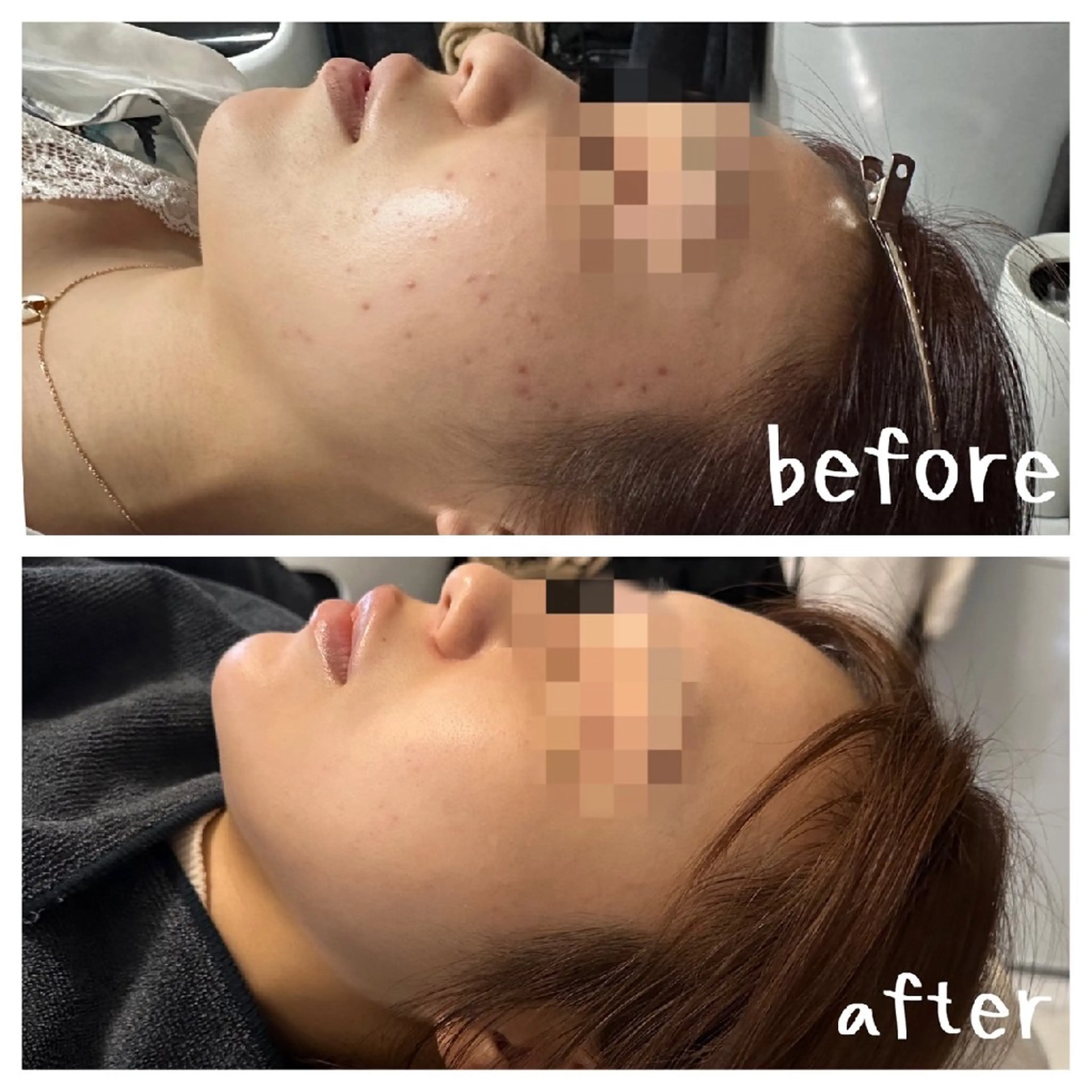 ✨OPEN記念✨ラテスパ&ハーブピーリング剥離あり《毛穴/ニキビ/肌荒れ/肌質改善》の写真