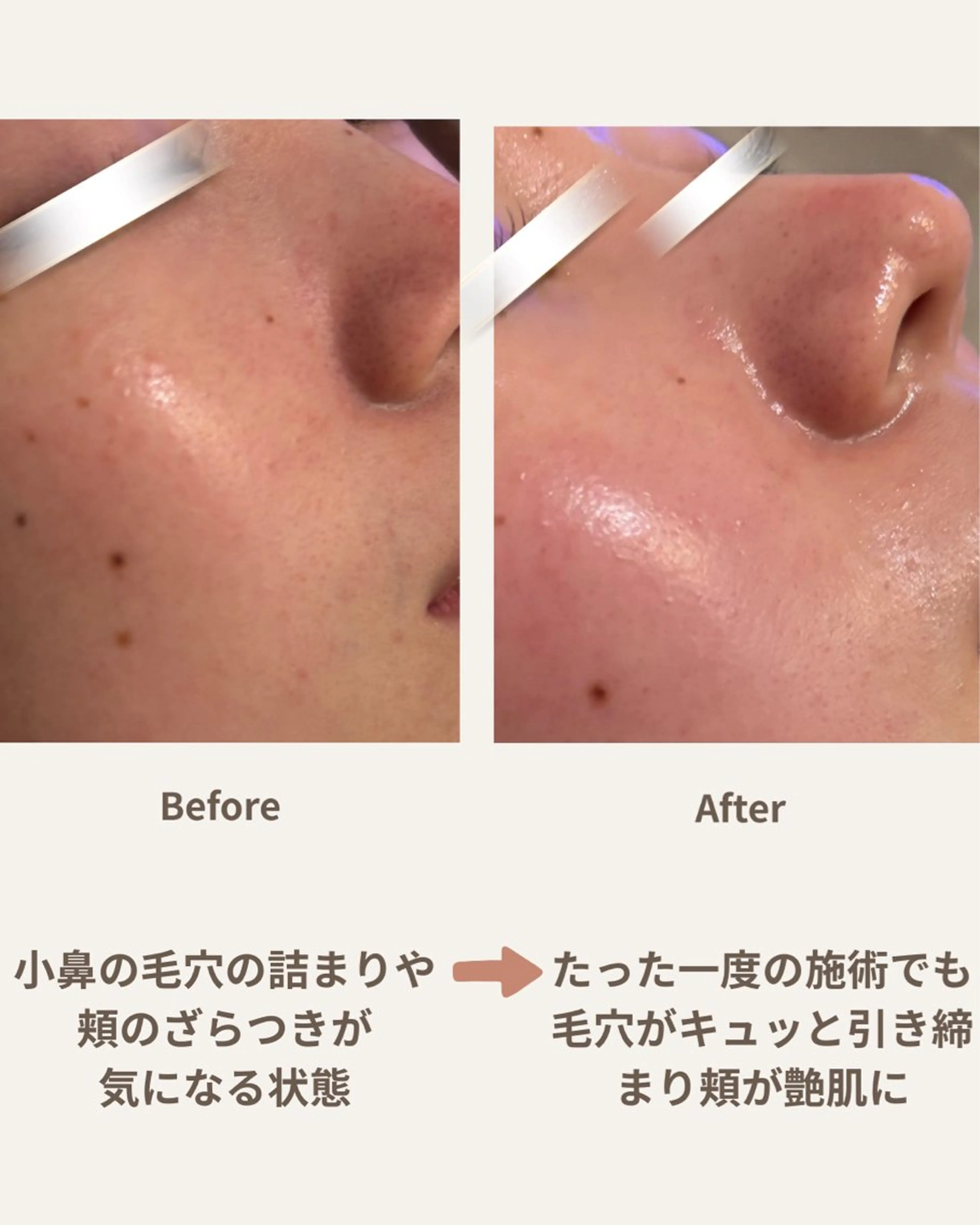 【先着5名様✨SNSモニター】最新4in1次世代ピーリング＋酸素導入（90分）江戸川区初導入マシンの写真