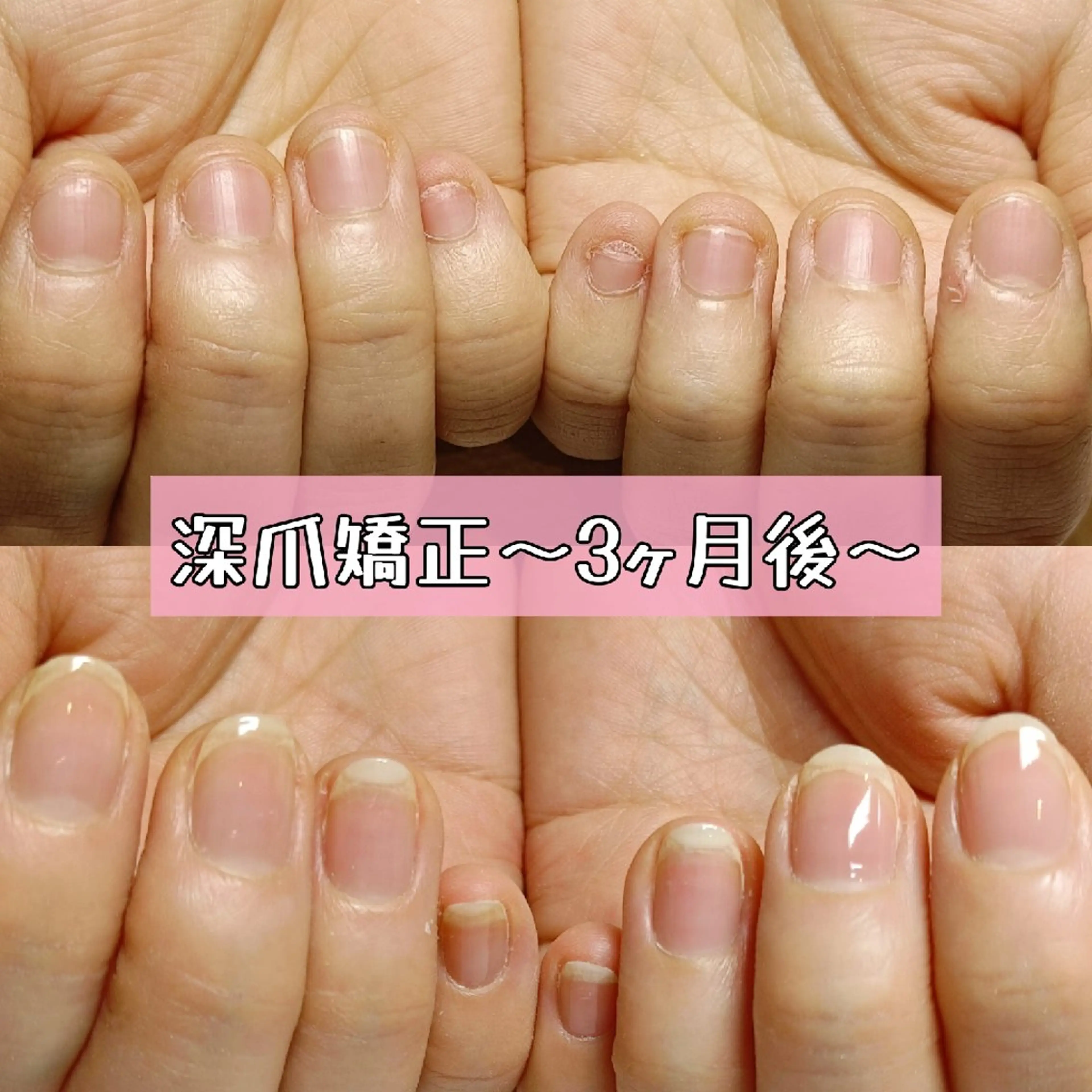 ネイル ハンドネイル ハンドケア 深爪矯正/爪育成ケア manie nailのネイルデザイン