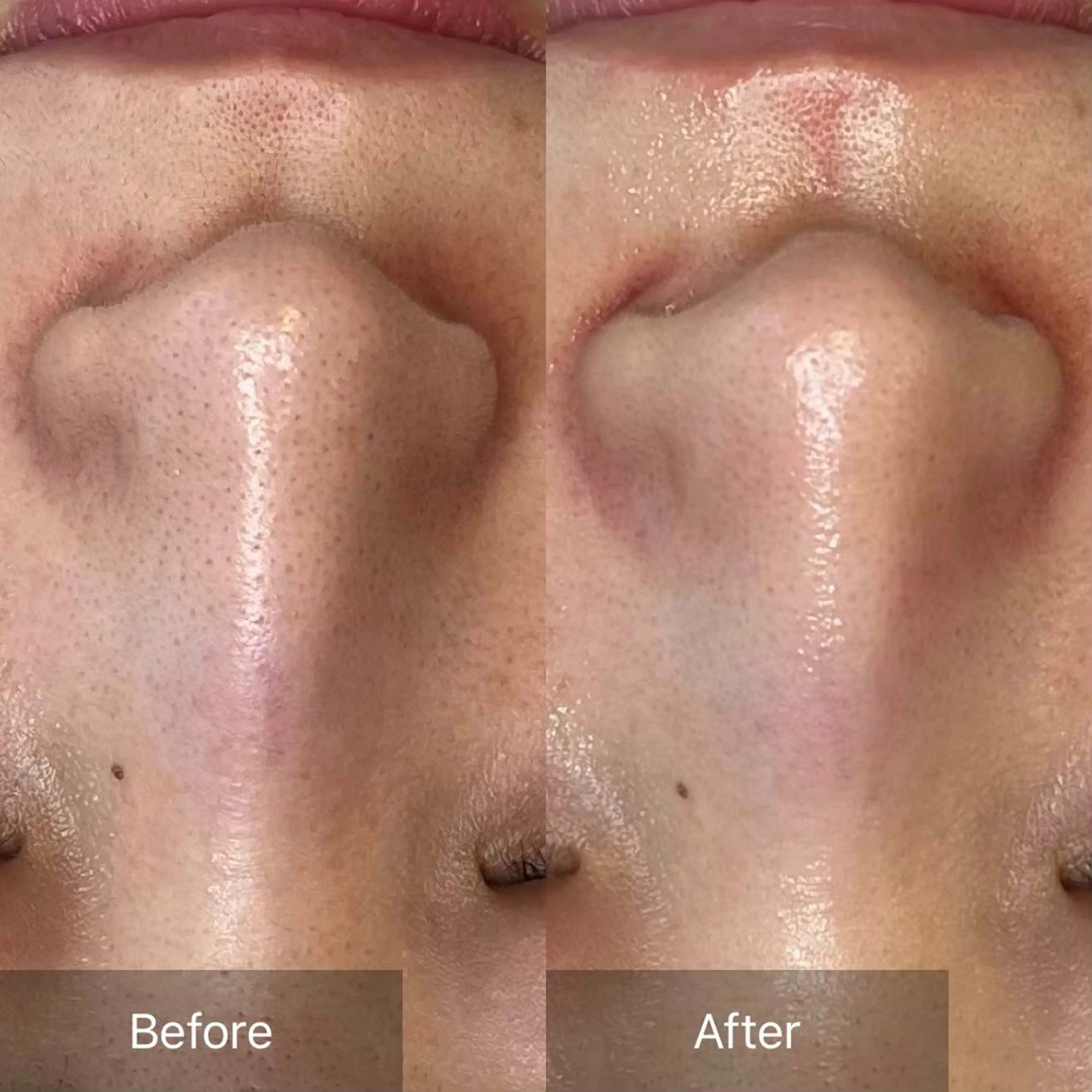 【毛穴ケア・引き締め】ハイドラ・ダイヤモンドピール💎症例写真の撮影可能な方📷の写真