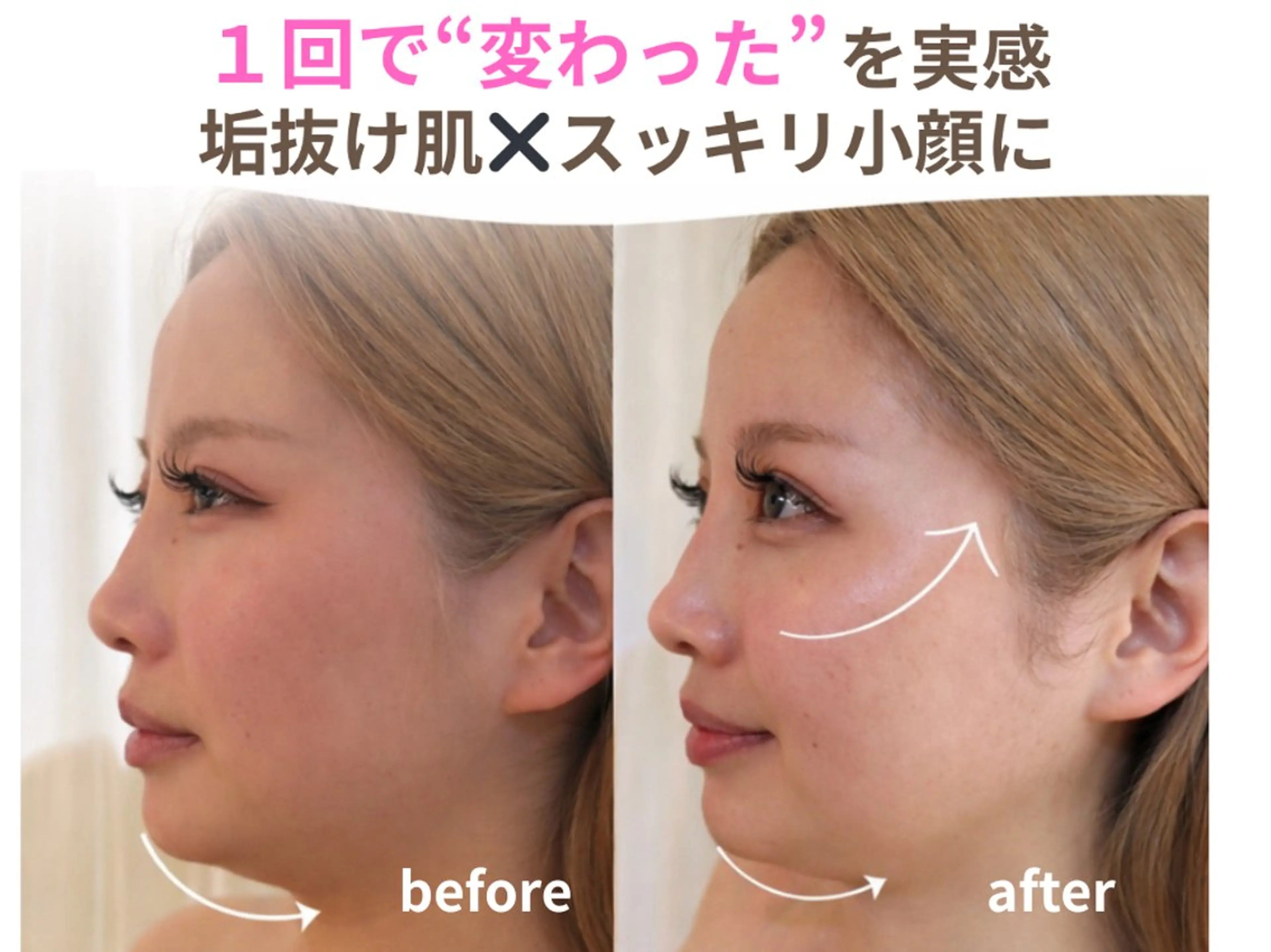 小顔矯正のみ🪄お試し3回目までこちらの価格OK💫　痛みの少ない小顔矯正💫の写真