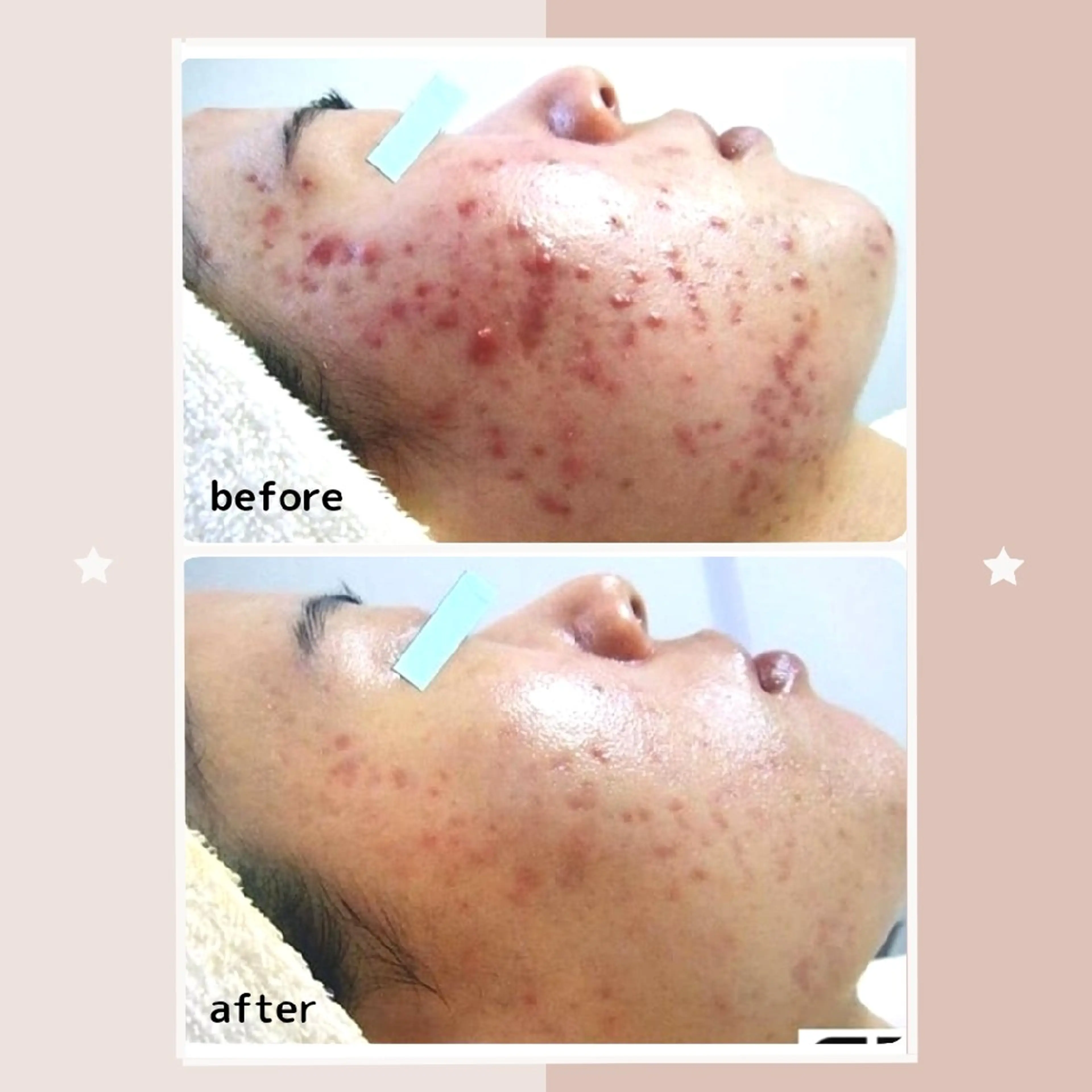 ニキビ・ニキビ跡専門 レゾン京橋店　のエステ・リラクイメージ