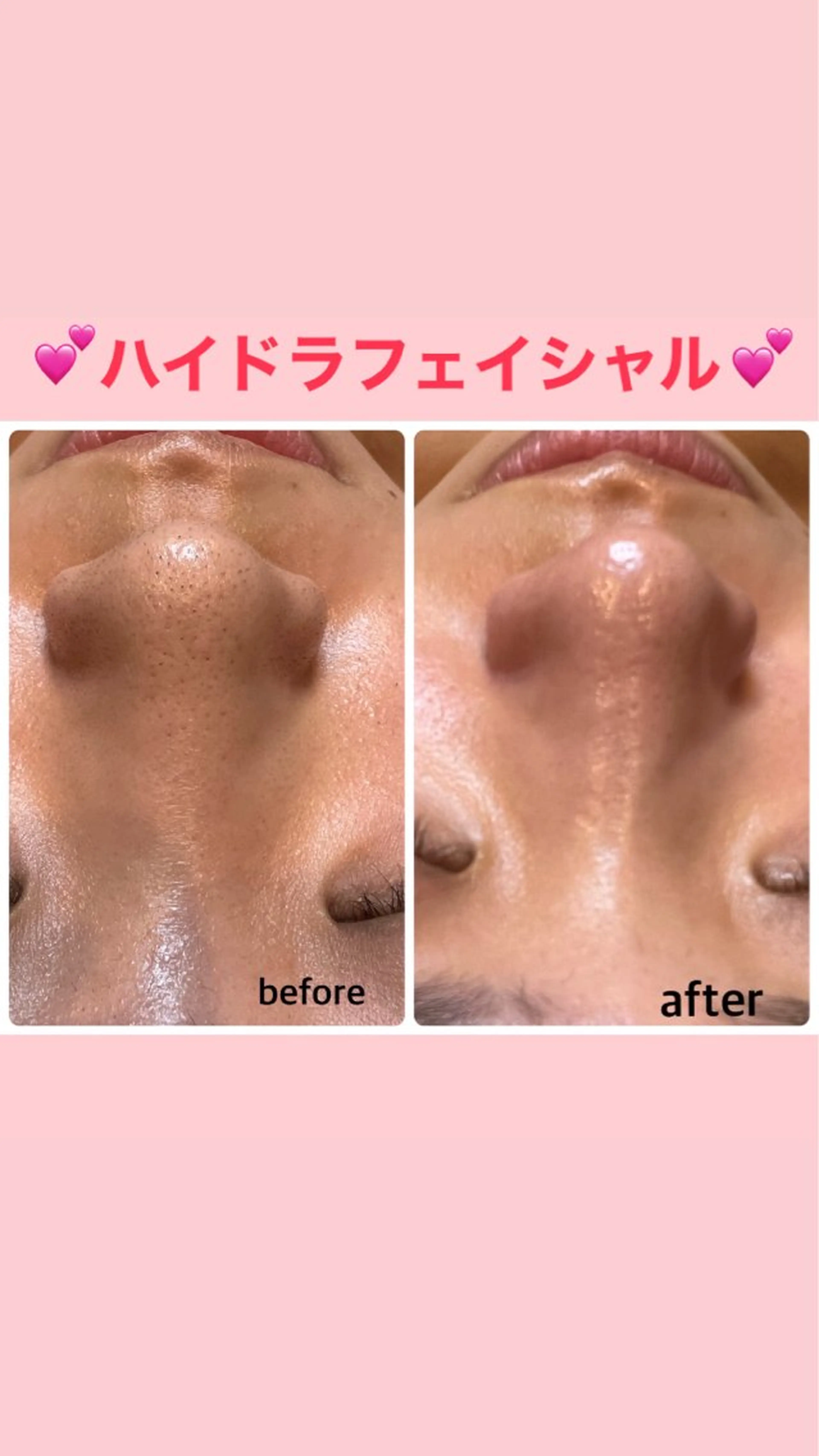 ハイドラピーリング　定価¥8800の写真