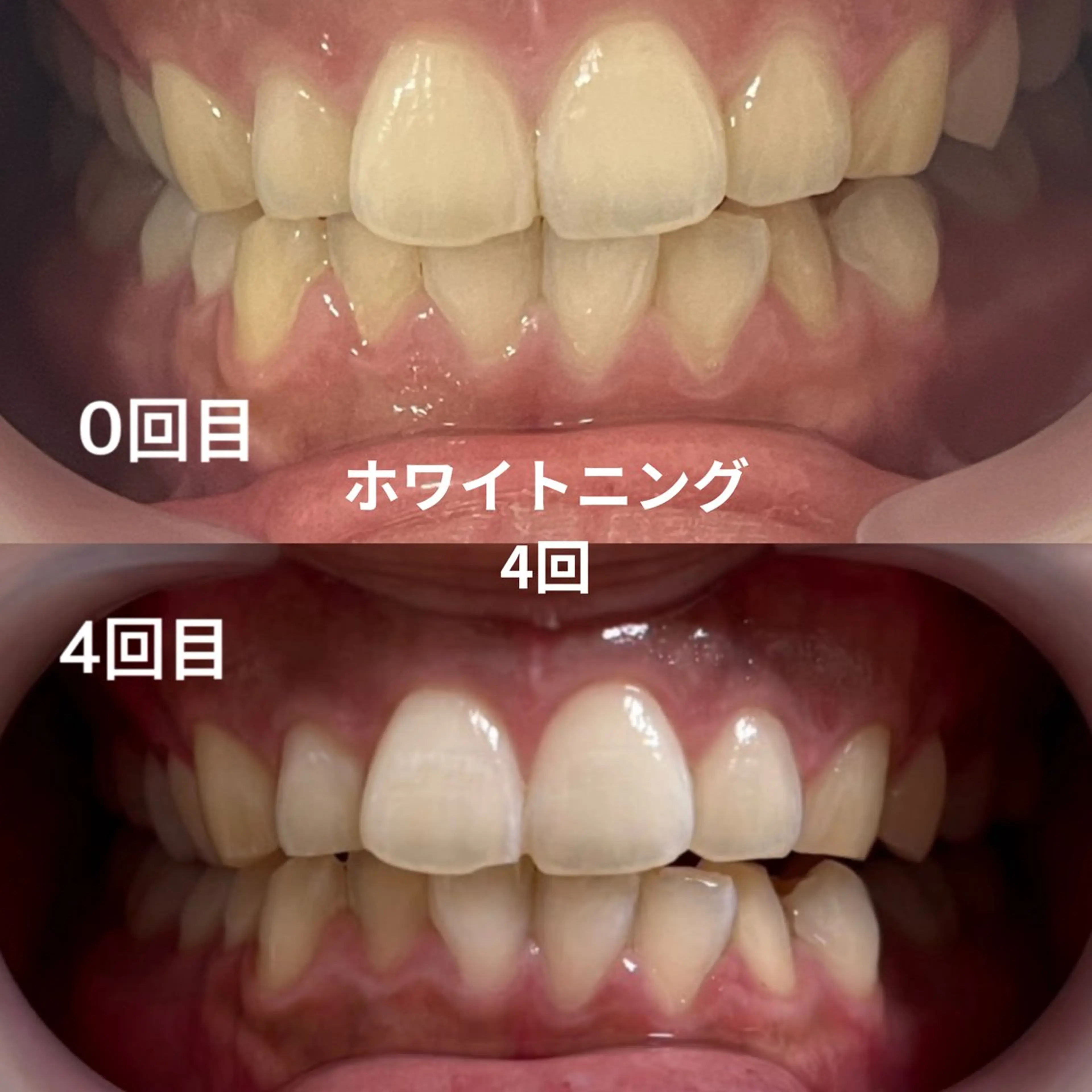 セルフホワイトニング 15分 6,200円→3,300円の写真