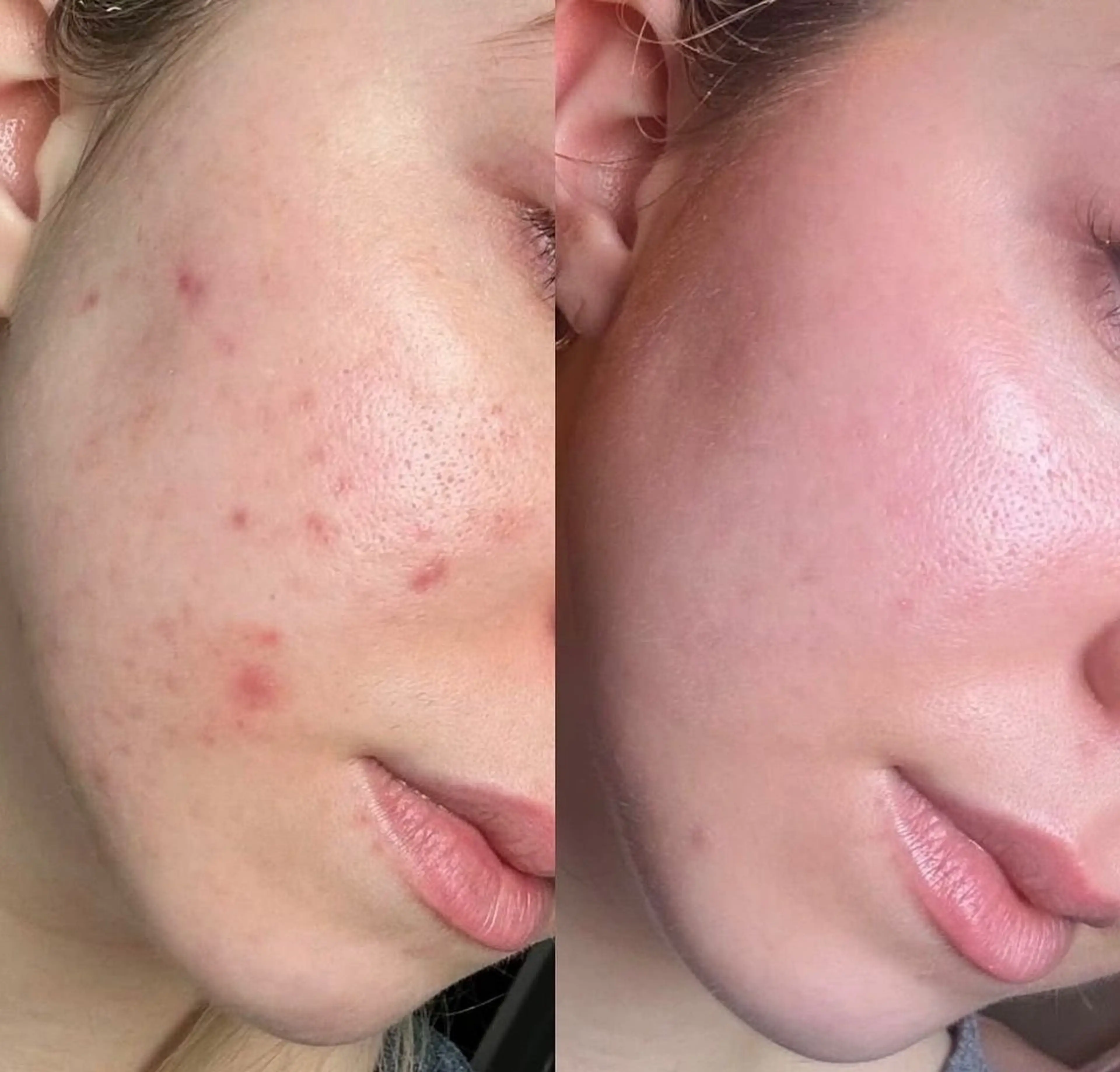 ニキビ専用メニュー🌹徹底的ニキビ退治😶‍🌫️毛穴洗浄✨プラズマ&よもぎ泡パック🫧で殺菌保湿！の写真