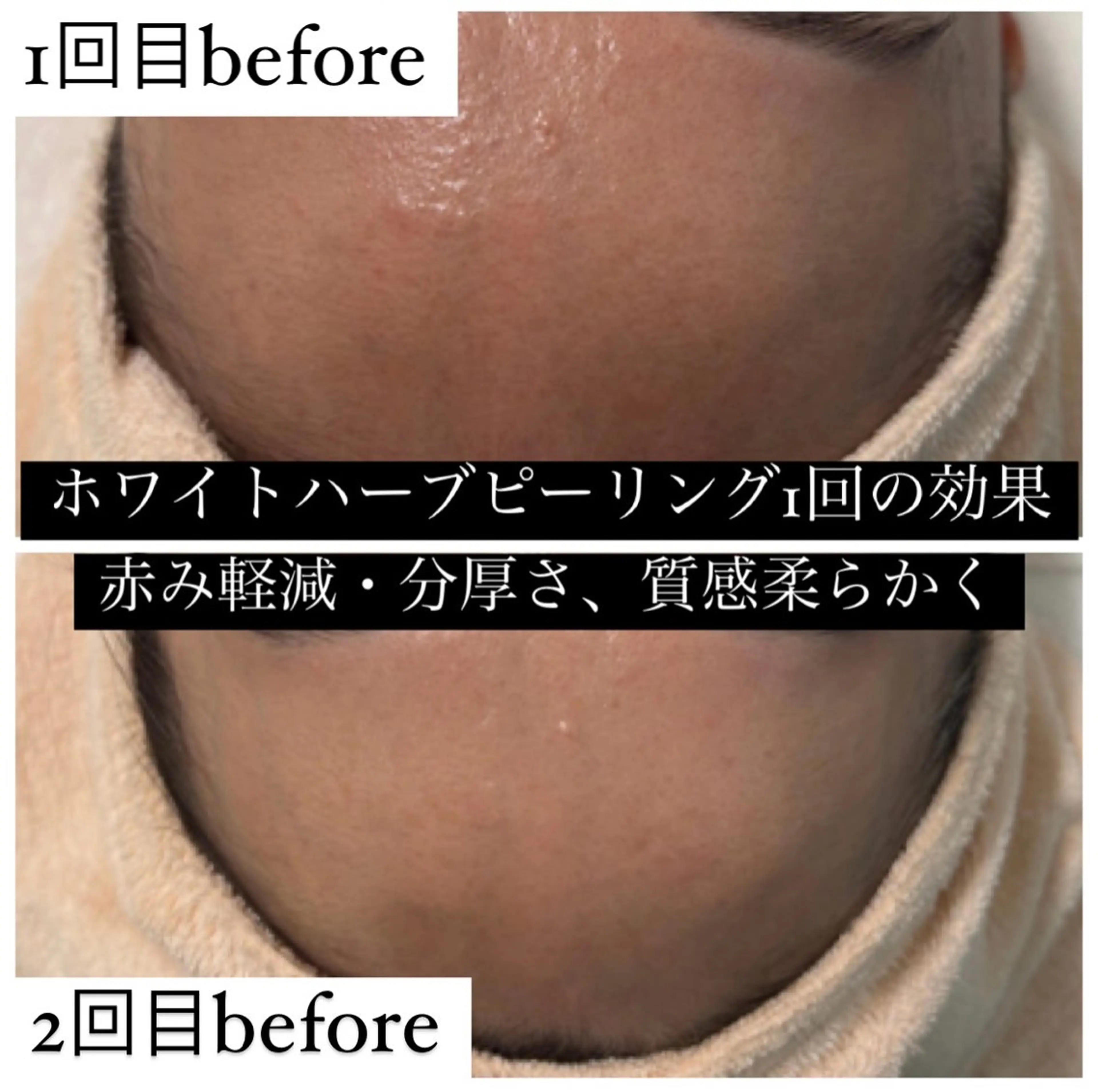 エステ 【ハーブピーリング】 Allumentのエステ・リラクイメージ