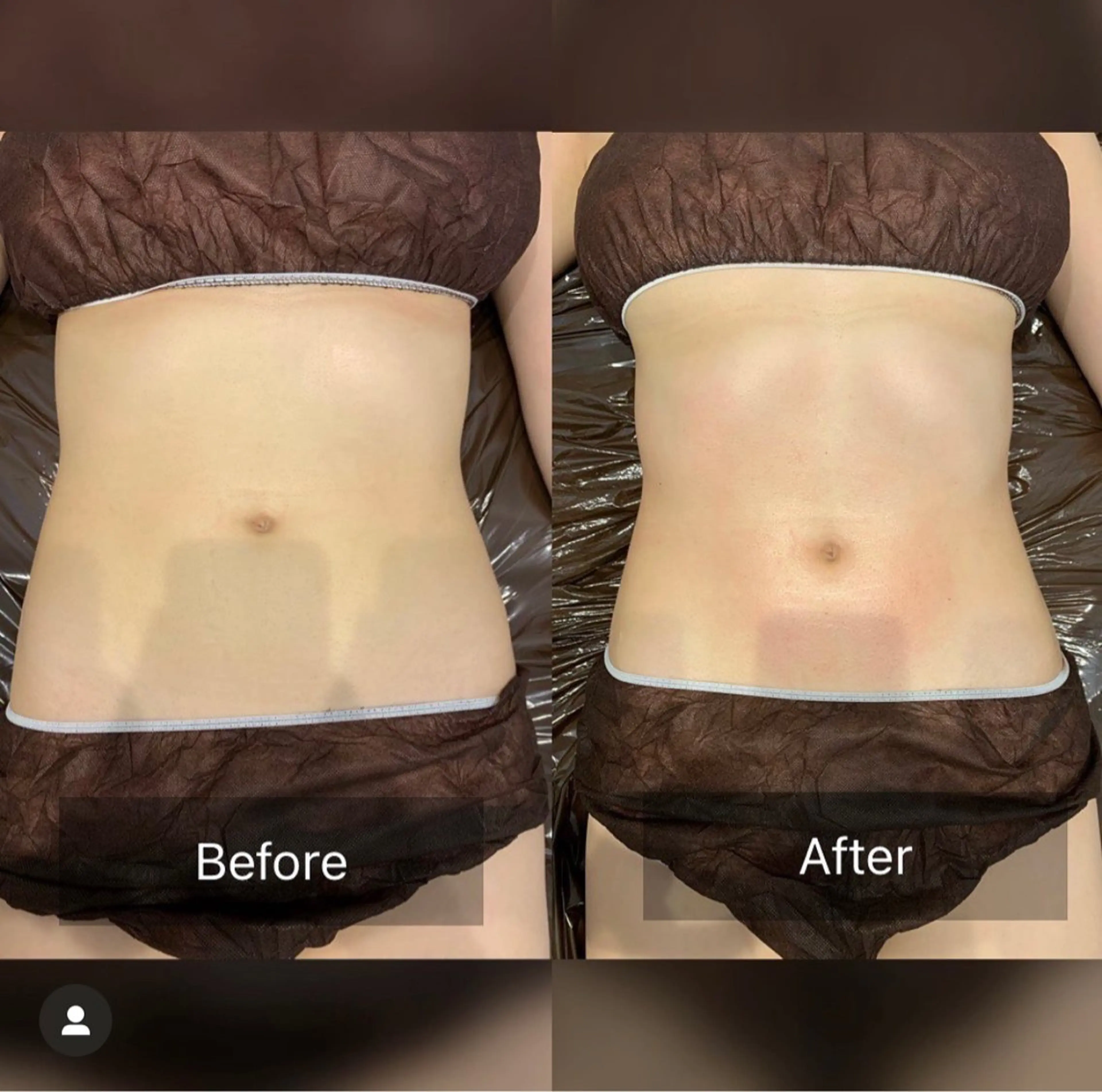 痩身エステ〔お得な選べる1部位〕の写真