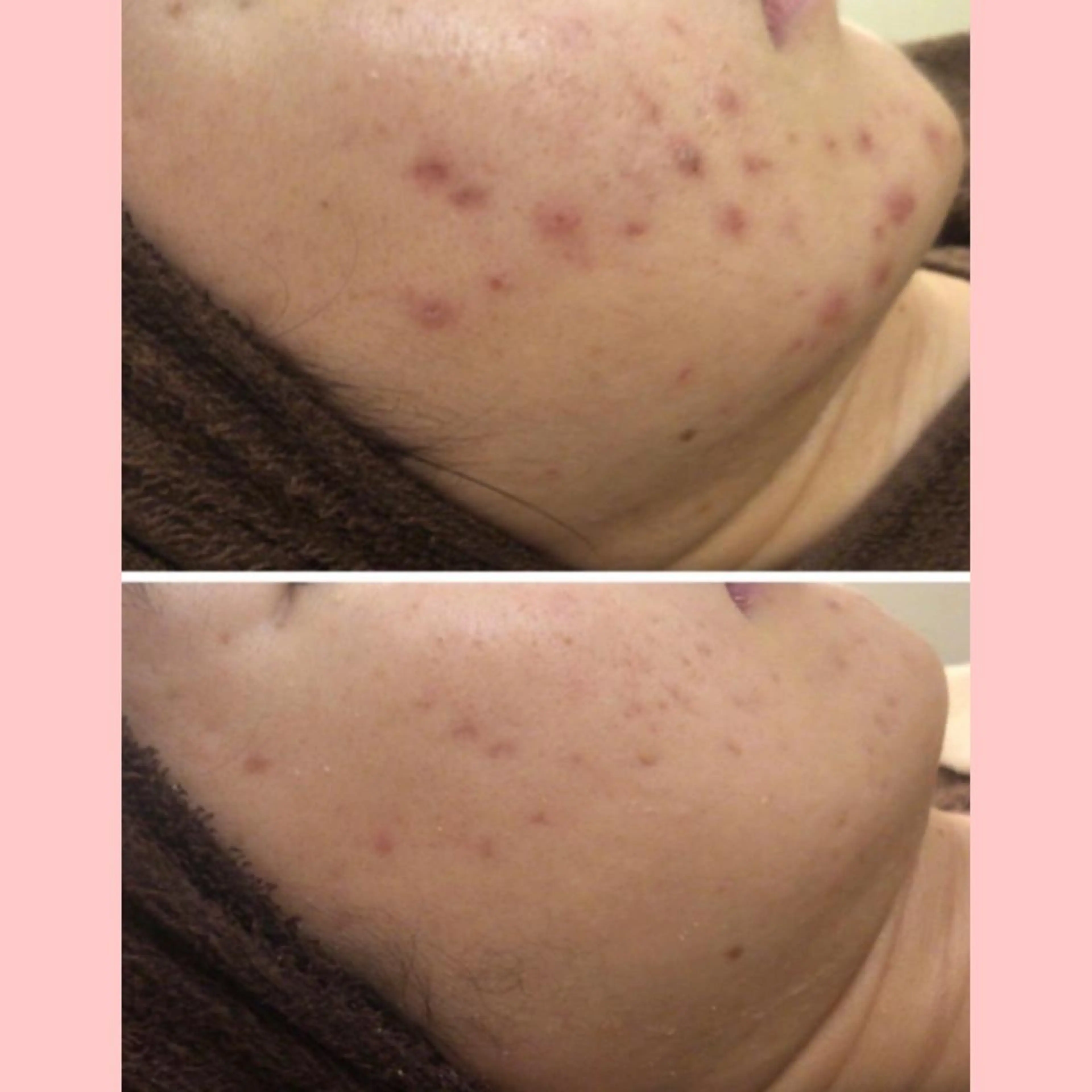 セミロング カラー パーマ ヘアアレンジ メンズ キッズ ネイル マツエク・マツパ アイブロウ 3か月で肌革命👼 ニキビ専門店💫のエステ・リラクイメージ