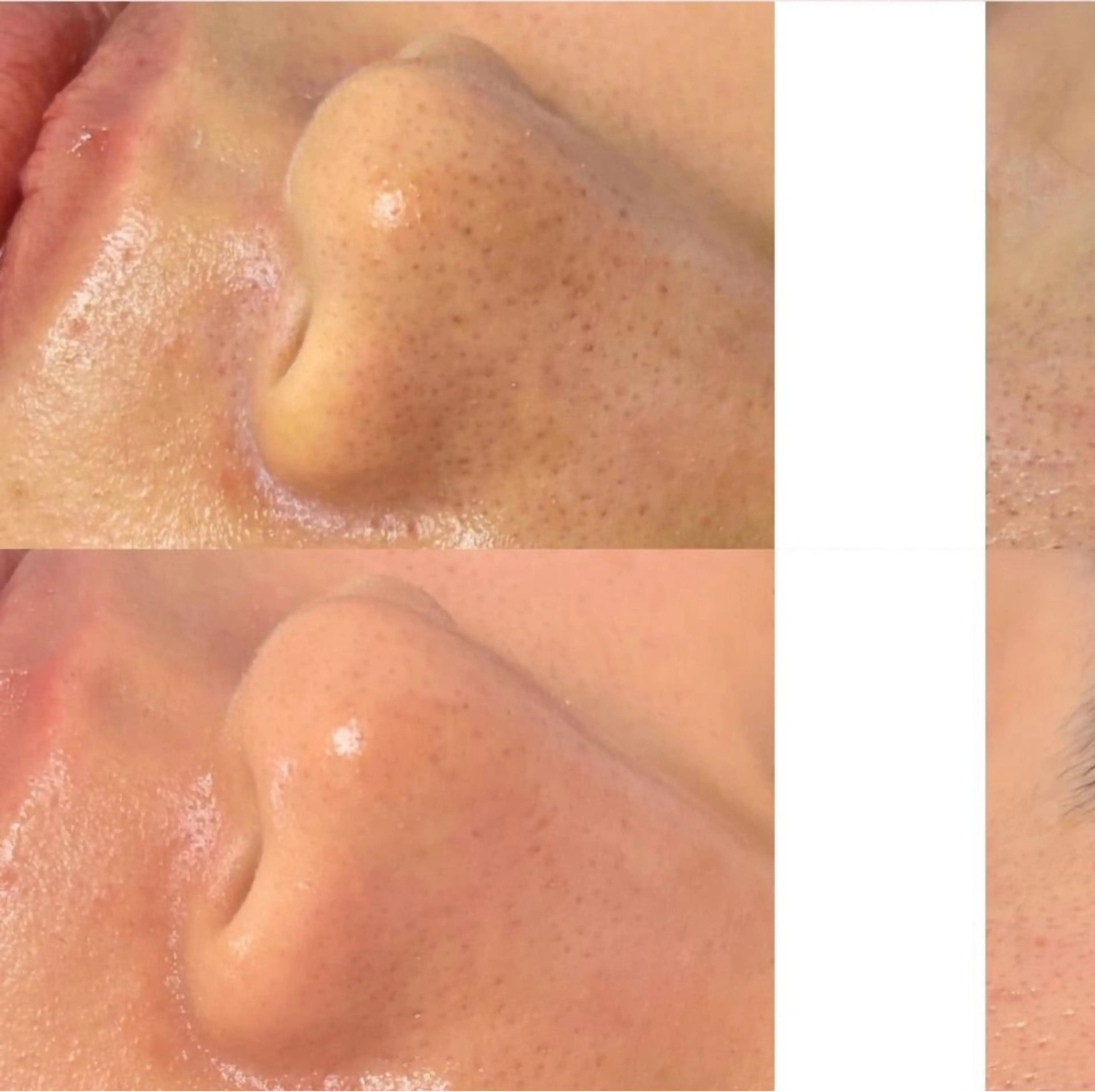 美肌毛穴ケア/看護師 🌷ナスサロmanaのエステ・リラクイメージ