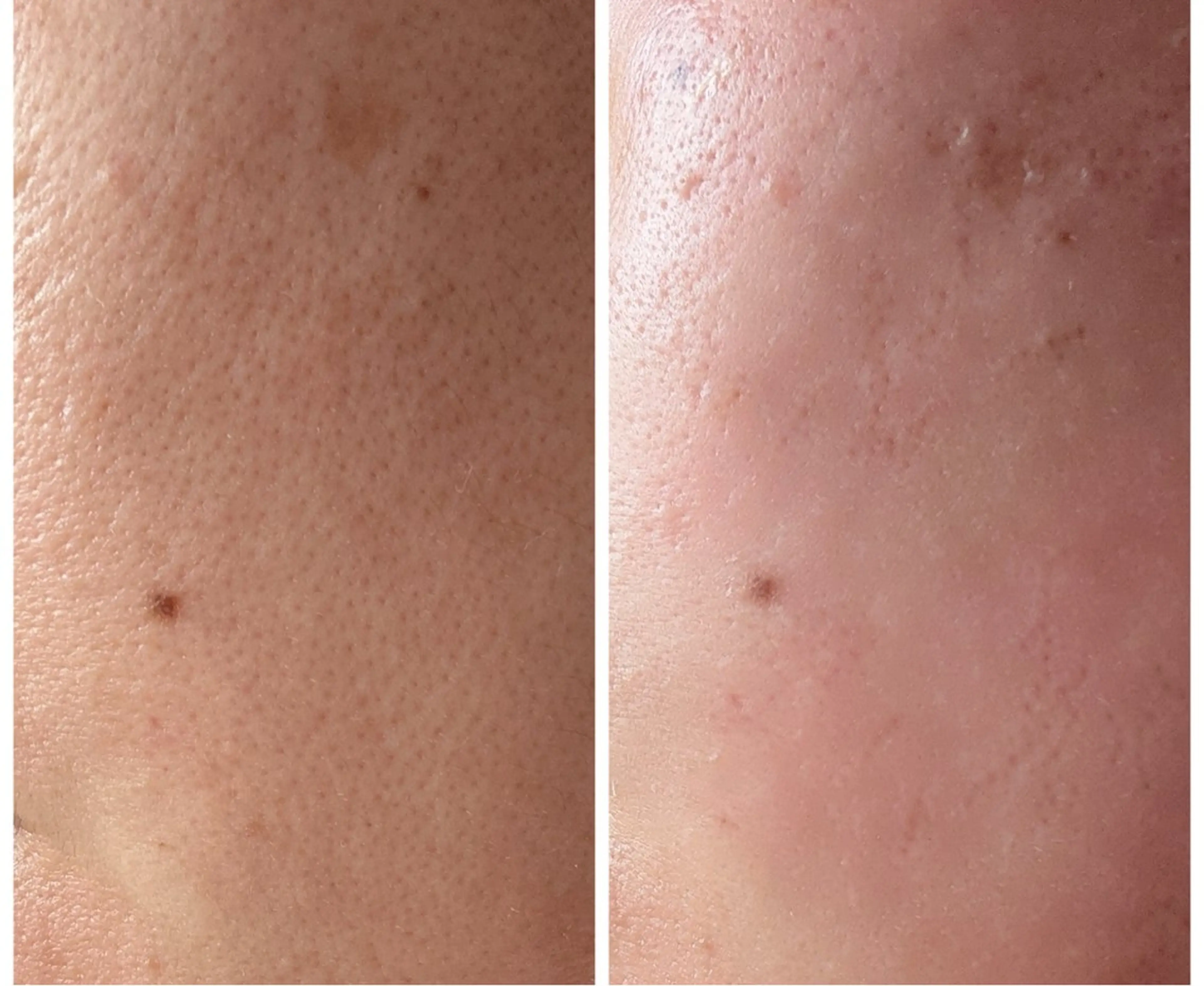 お顔全体ワックス脱毛で毛穴ケア♪潤艶美肌へ♪の写真