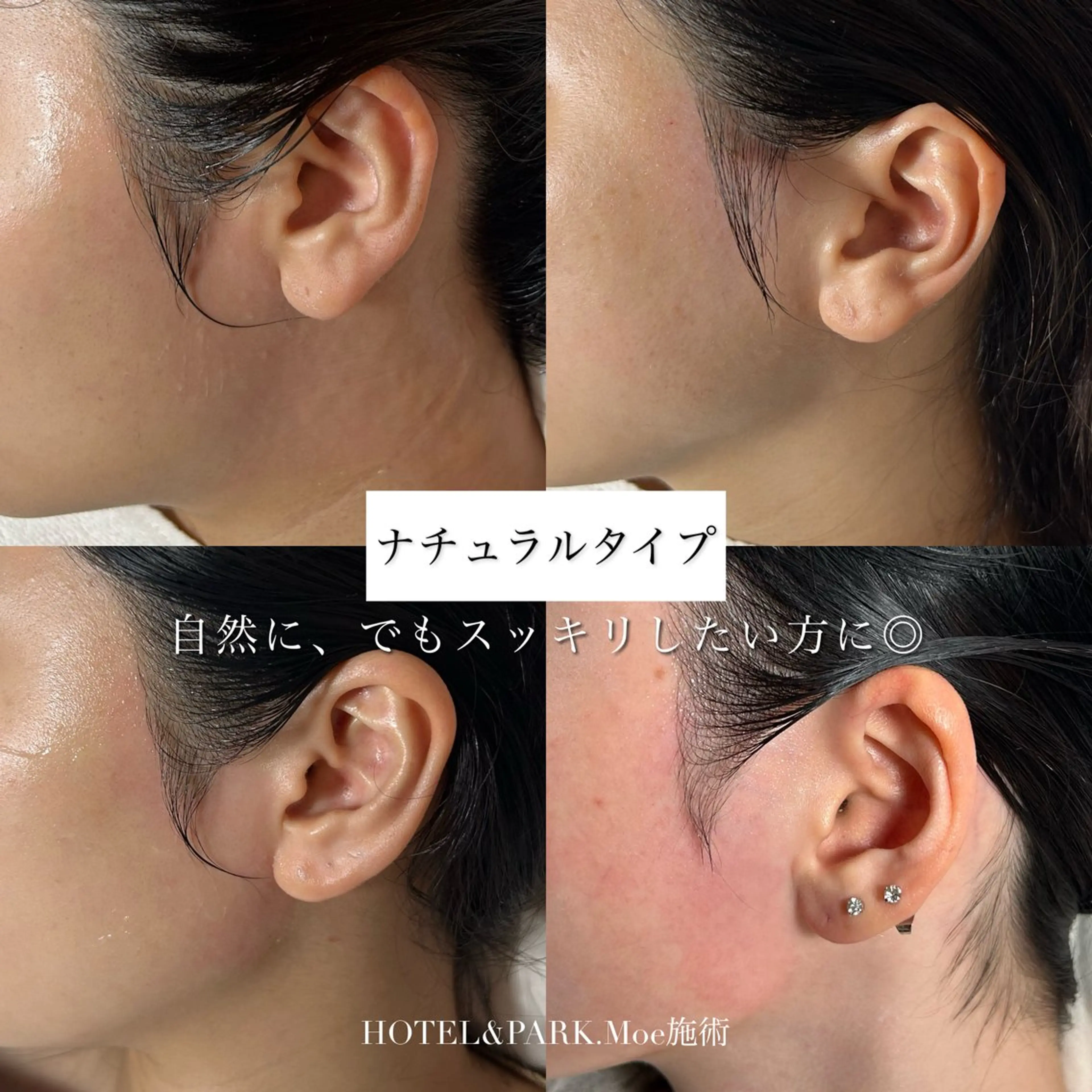 脱毛 HOTEL&PARK .Moeワックス脱毛のエステ・リラクイメージ