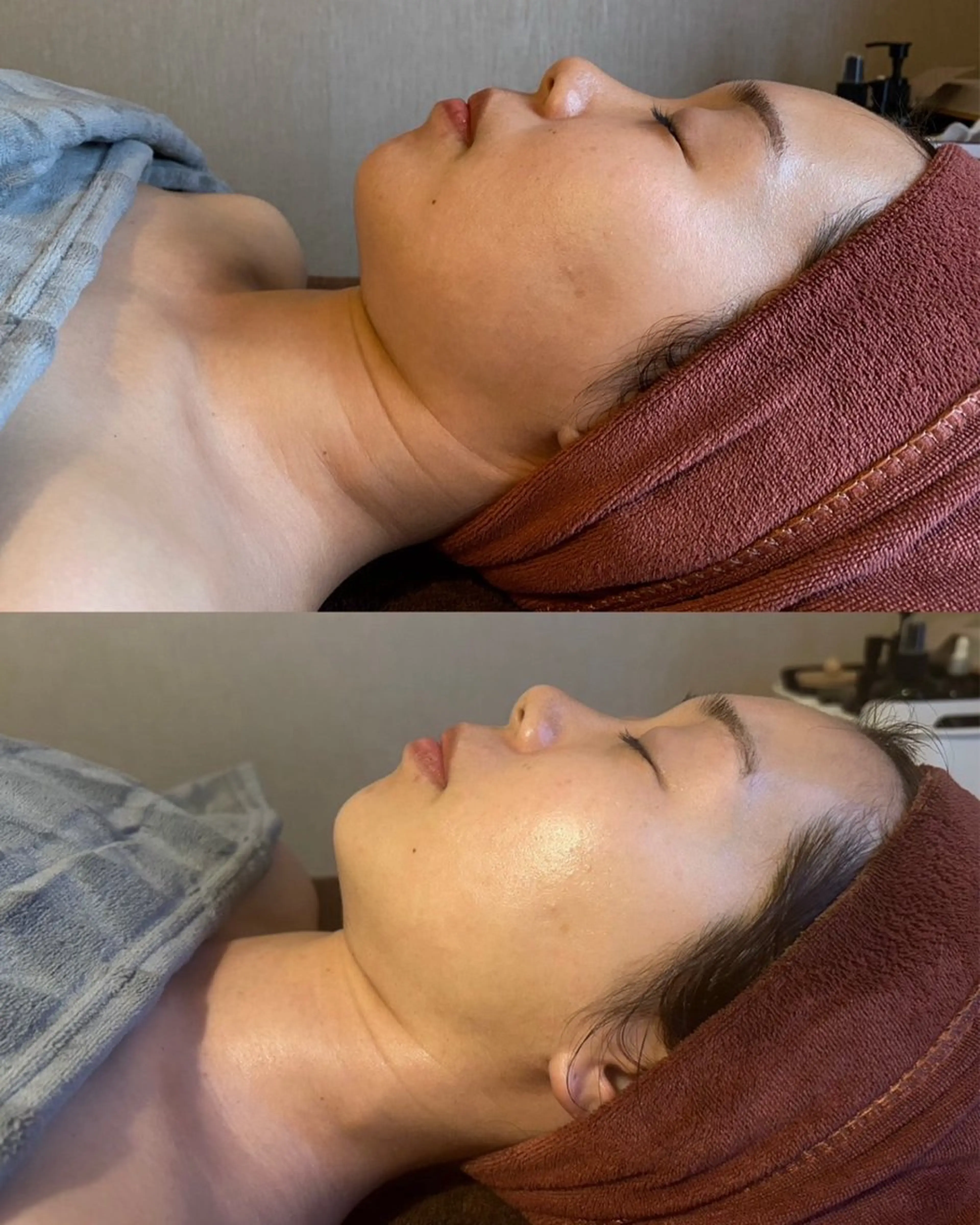 【水素トリートメント】幹細胞ケアで若い日のお肌に🫧minimo限定、血流マッサージ付き！の写真