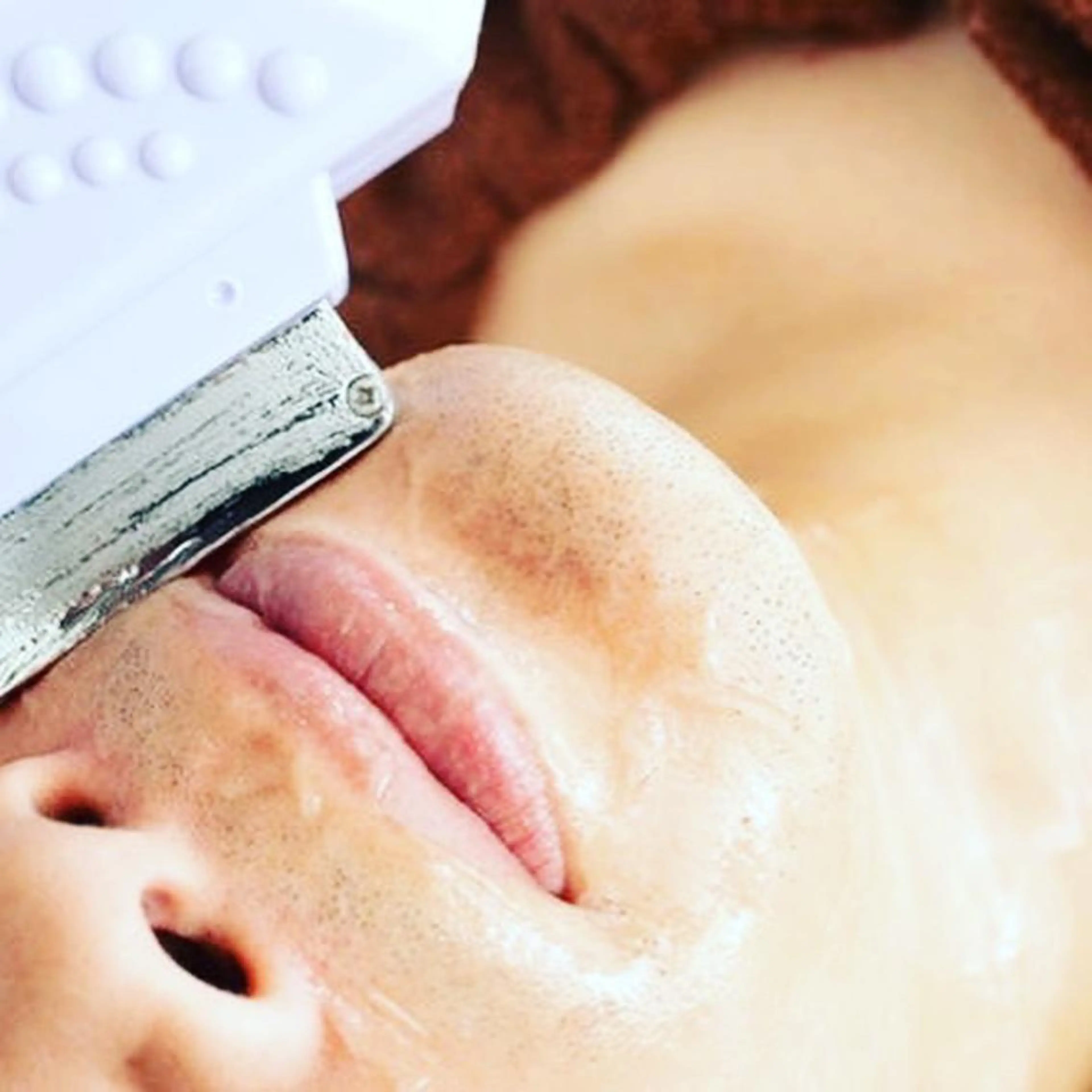 初回メンズヒゲ脱毛　1ヶ所の写真