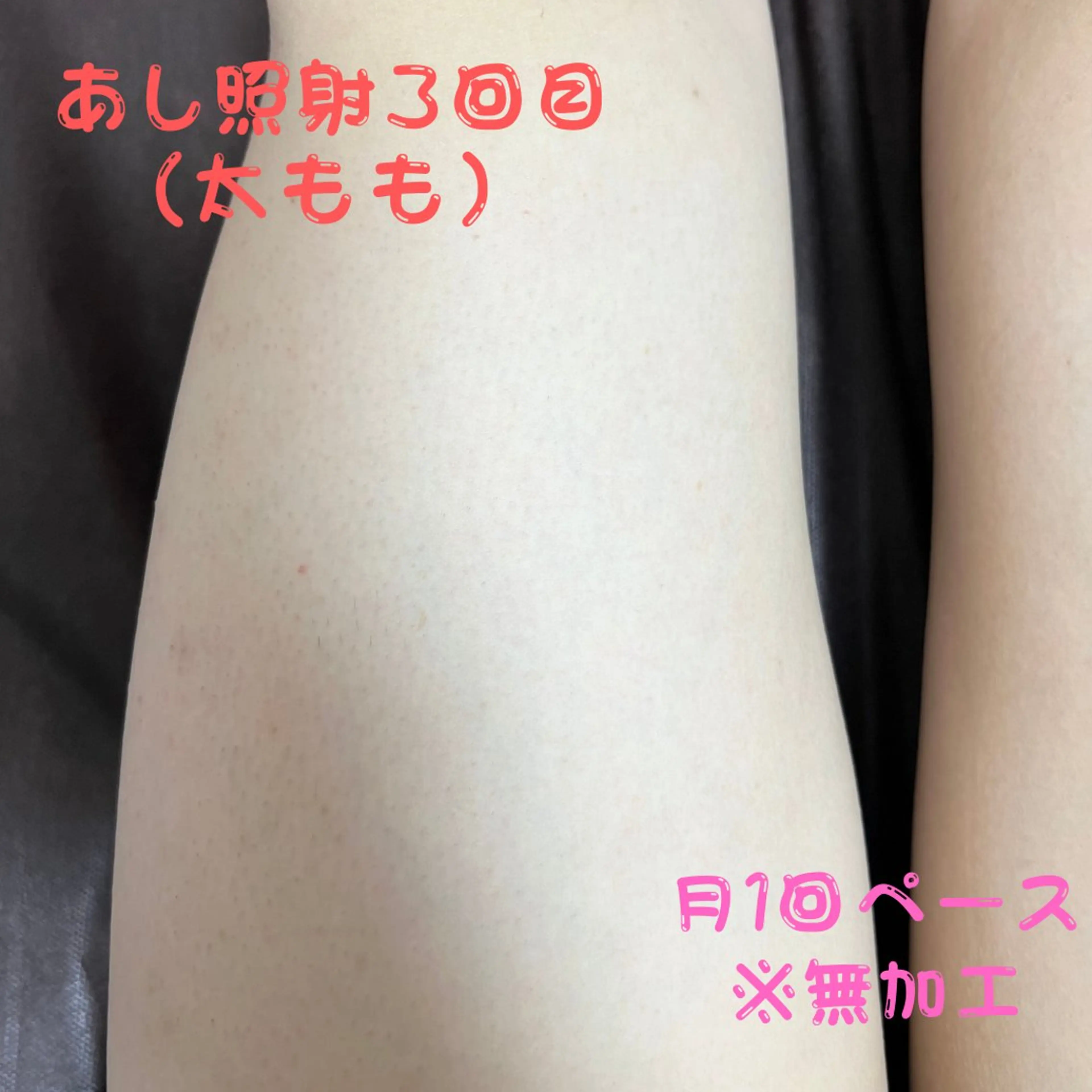 メンズ キッズ 脱毛 メンズ脱毛フェリッセ /男女🆗キッズ🆗のエステ・リラクイメージ