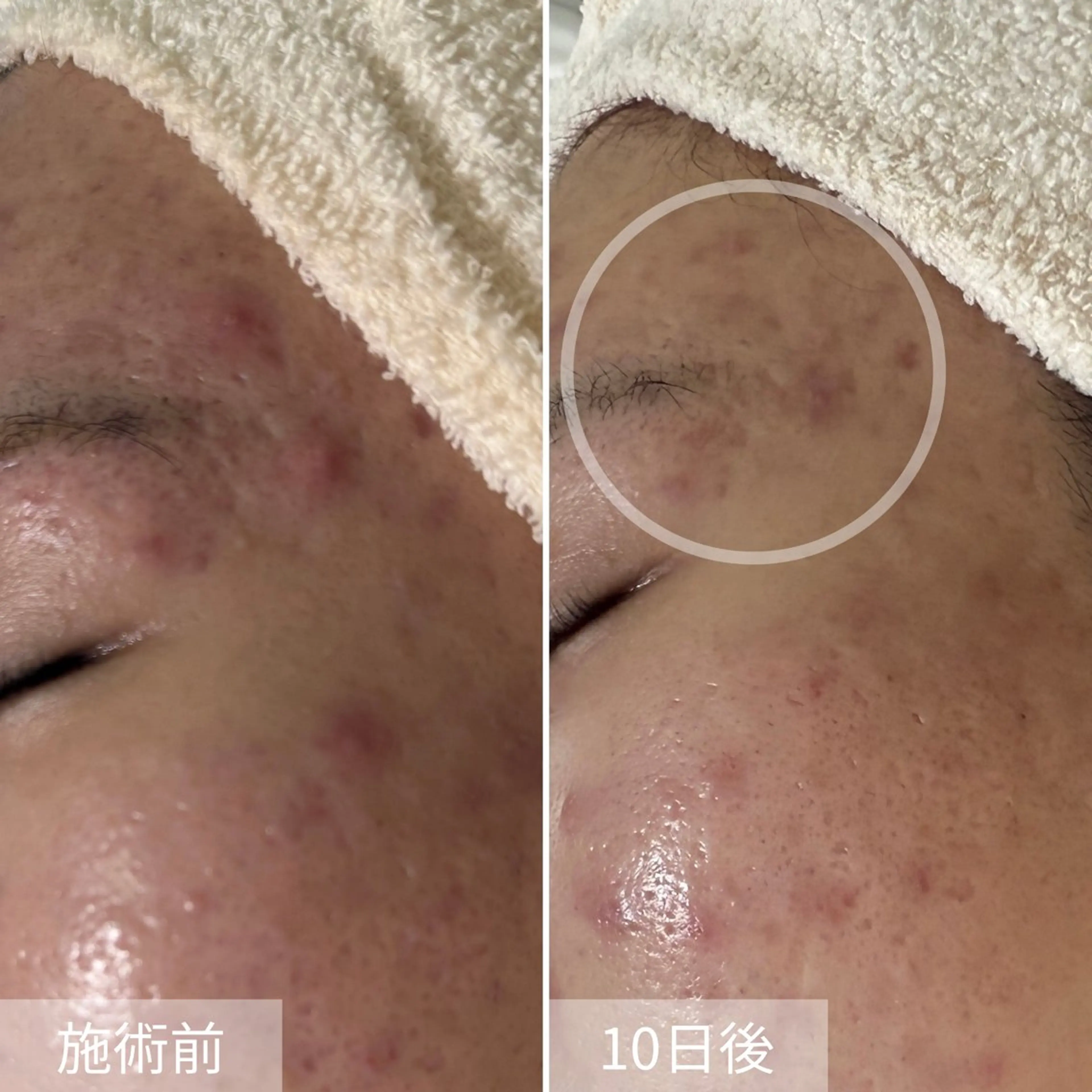 エステ ニキビ・毛穴・ フェイシャル専門店のエステ・リラクイメージ