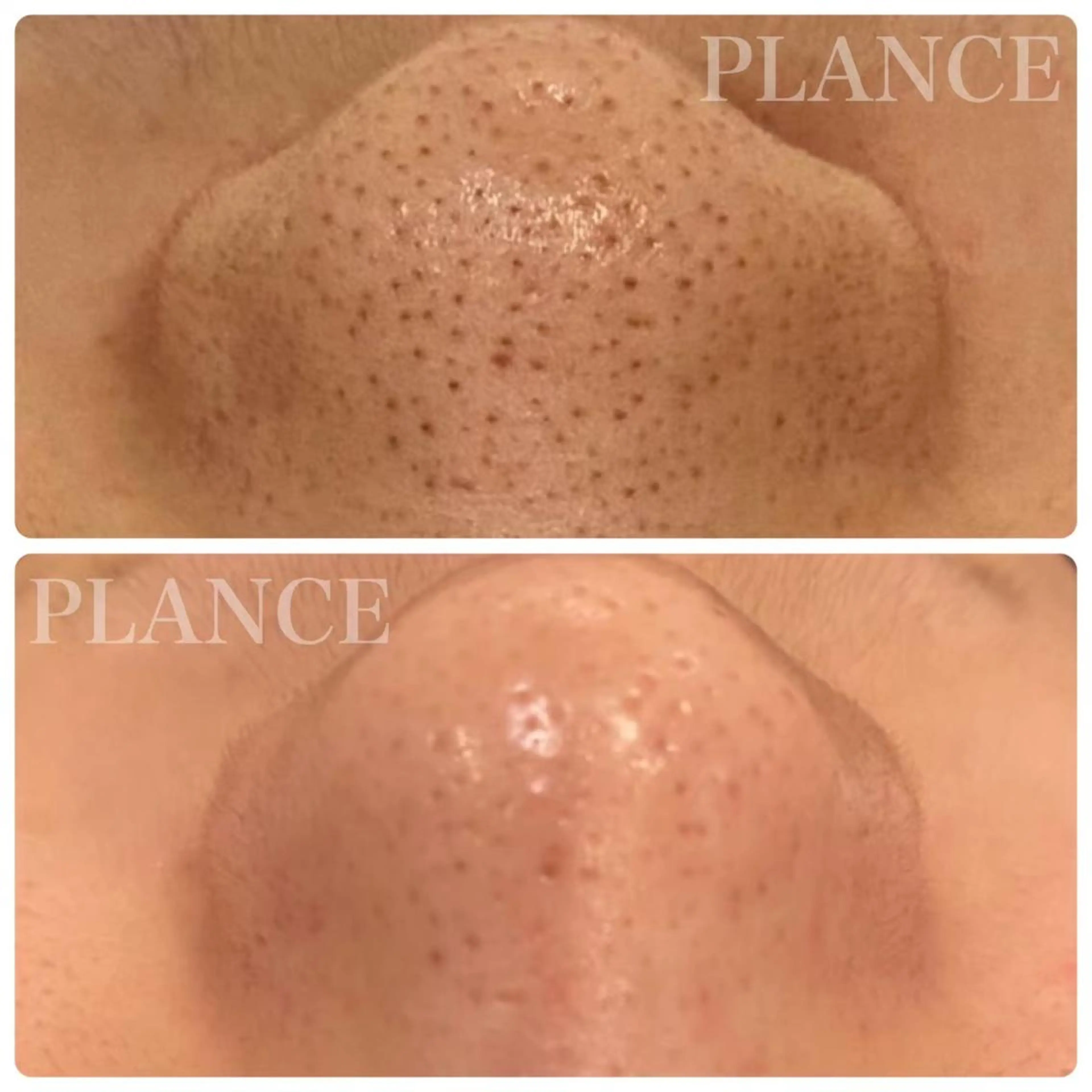 エステ フェイシャル専門 肌質改善/プランスのエステ・リラクイメージ