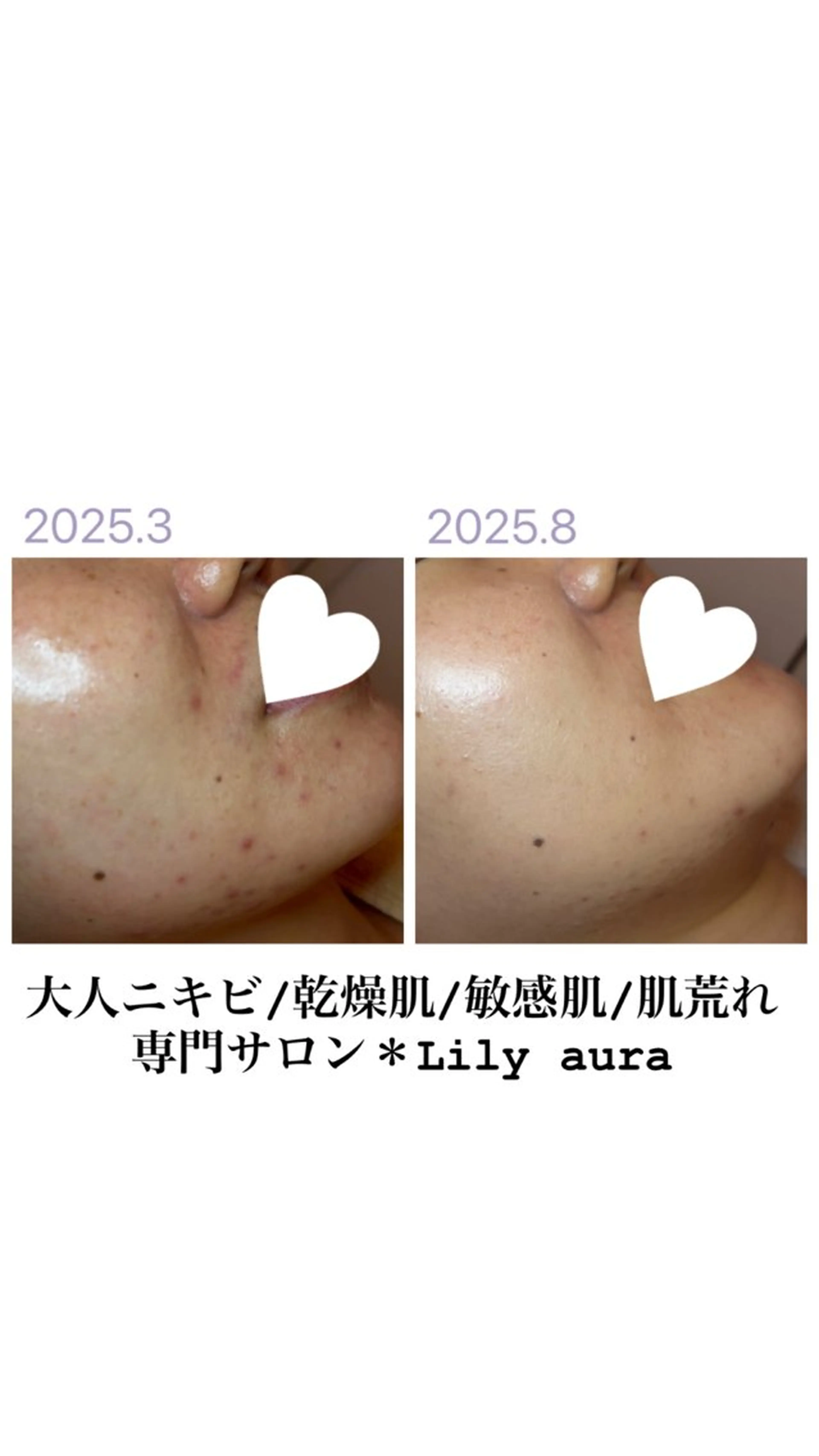 人気No. 1🏆肌荒れ改善/翌日のお化粧ノリばっちり👍お鼻つるつる、むくみ撃退、つや肌仕上げ/痛み・ダウンタイムなしの写真