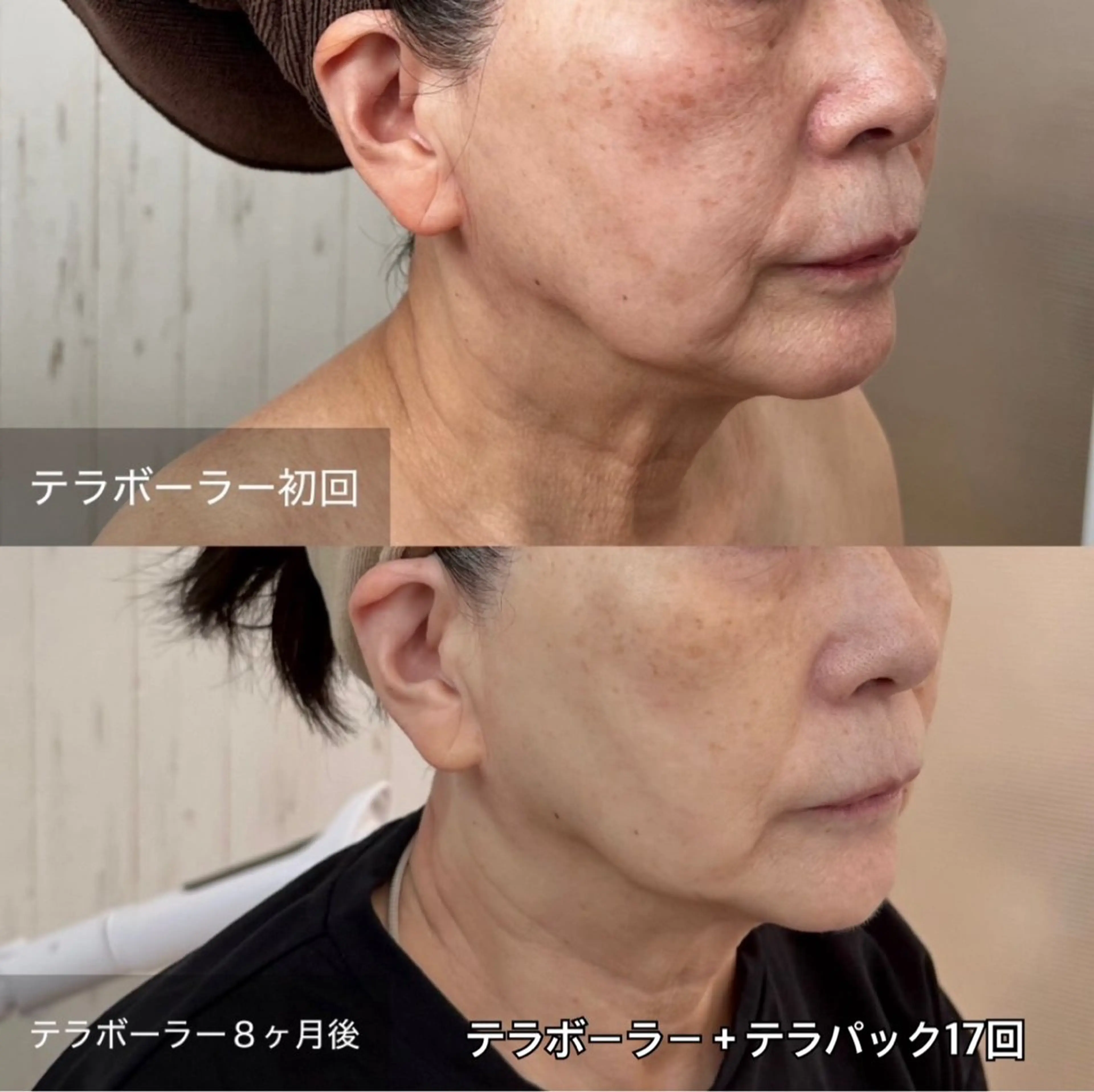 その他 ielu〜毛穴ケア ハーブピーリングのエステ・リラクイメージ