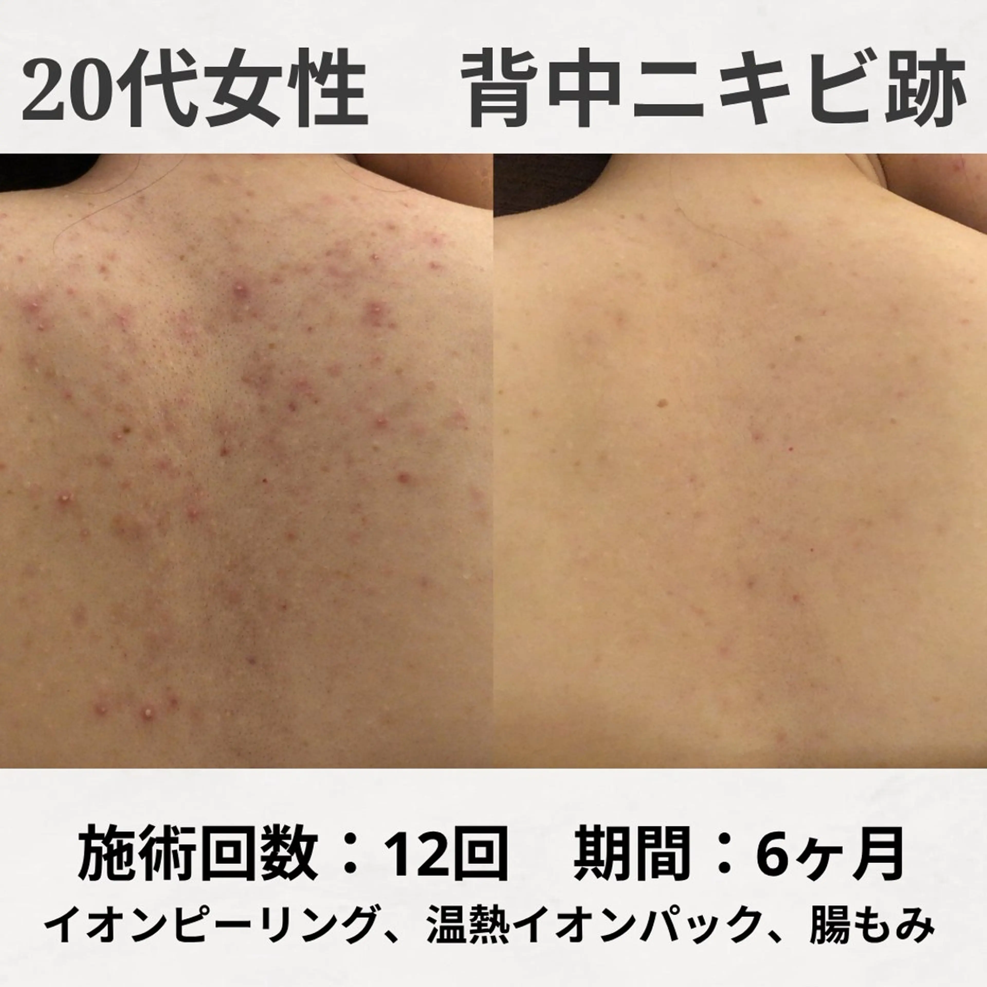 エステ リラク ニキビ跡改善専門🔥 医療にはできない改善のエステ・リラクイメージ